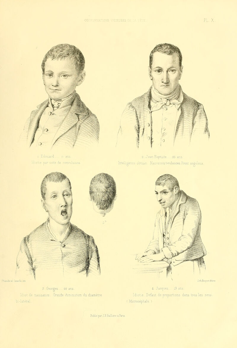 o .. ■ f * , > . . riSt ; Edouard.,., n ans. idiotie par suite de convulsions. 2 . Jean Baptiste.... 23 ans. S Thoreih M lévellk hth 3. Georges .. 22 ans. Idiot de naissance Grande diminution du diamètre bi-latéral. Intelligence obtuse. Mauvaises tendances.Front anguleux. o Û li?h_Beco-Jet frères 4. Jacques... 19 ans. Idiotie. Défaut de proportions dans tous les sens. Microcéphale. ) PuMiepar J.B.Ea'.lkere a?a?is