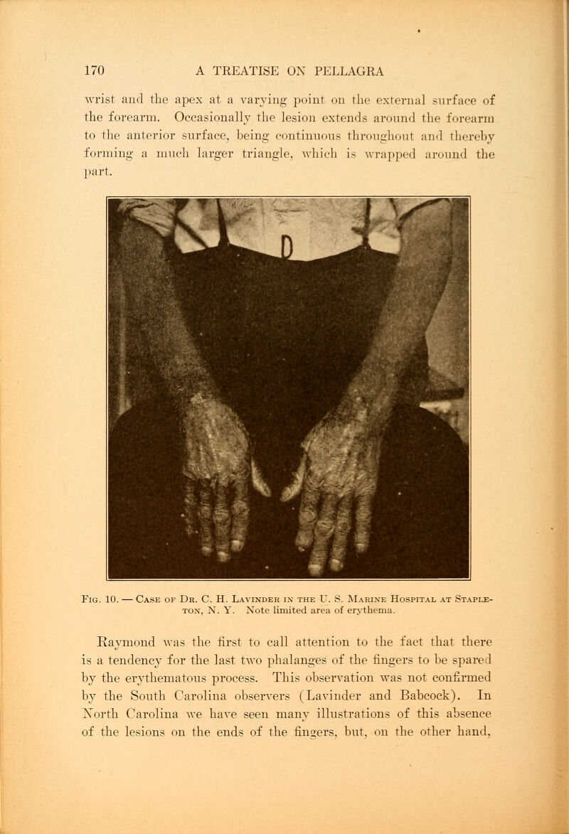 wrist and the apex at a varying point on the external surface of the forearm. Occasionally the lesion extends around the forearm to the anterior surface, being continuous throughout and thereby forming a much larger triangle, which is wrapped around the part. Fig. 10. — Case of Dr. C. H. Lavinder in the U. S. Marine Hospital at Staple- ton, N. Y. Note limited area of erythema. Raymond was the first to call attention to the fact that there is a tendency for the last two phalanges of the fingers to be spared by the erythematous process. This observation was not confirmed by the South Carolina observers (Lavinder and Babcock). In North Carolina we have seen many illustrations of this absence of the lesions on the ends of the finders, but, on the other hand,