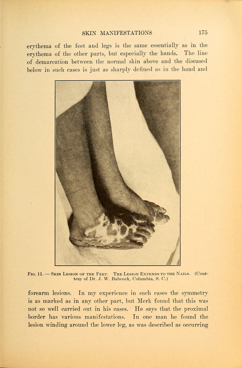 erythema of the feet and legs is the same essentially as in the erythema of the other parts, but especially the hands. The line of demarcation between the normal skin above and the diseased below in such cases is just as sharply defined as in the hand and Fig. 11. Skin Lesion of the Feet. The Lesion Extends to the Nails. tesy of Dr. J. W. Babcock, Columbia, S. C.) (Cour- forearm lesions. In my experience in such cases the symmetry is as marked as in any other part, but Merk found that this was not so well carried out in his cases. He says that the proximal border has various manifestations. In one man he found the lesion winding around the lower leg, as was described as occurring