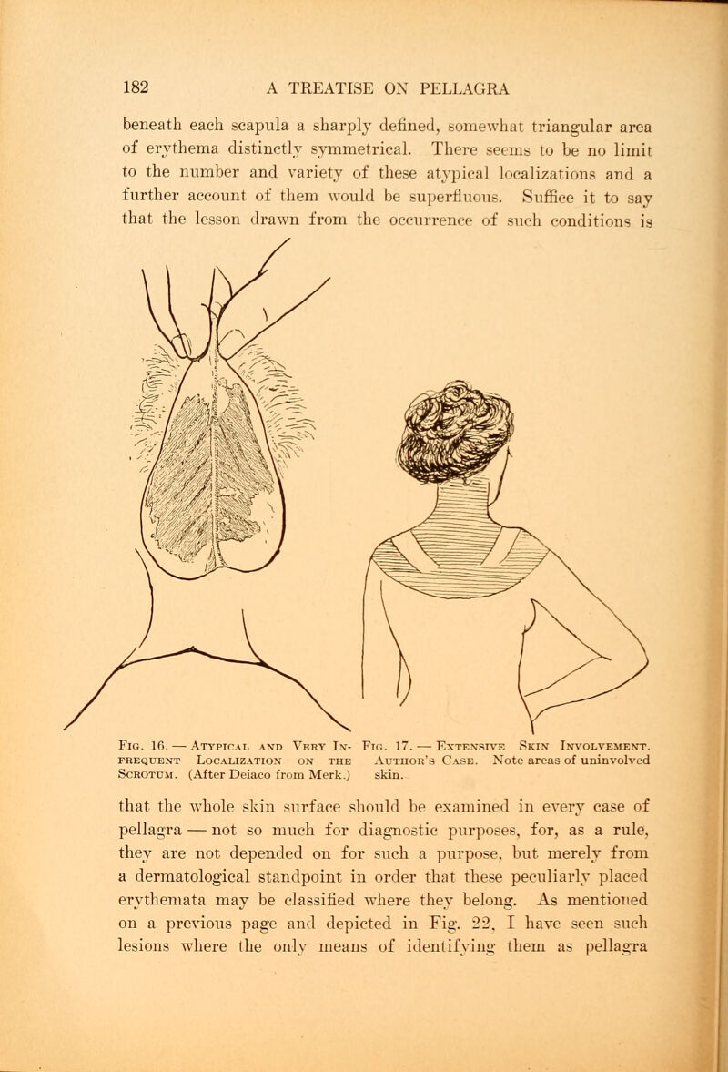 beneath each scapula a sharply defined, somewhat triangular area of erythema distinctly symmetrical. There seems to be no limit to the number and variety of these atypical localizations and a further account of them would be superfluous. Suffice it to say that the lesson drawn from the occurrence of such conditions is Fig. 16. — Atypical and Very In- Fig. 17. — Extensive Skin Involvement, frequent Localizatiox on the Author's Case. Note areas of uninvolved Scrotum. (After Deiaeo from Merk.) skin. that the whole skin surface should be examined in every case of pellagra — not so much for diagnostic purposes, for, as a rule, they are not depended on for such a purpose, but merely from a dermatological standpoint in order that these peculiarly placed erythemata may be classified where they belong. As mentioned on a previous page and depicted in Fig. 22. I have seen such lesions where the only means of identifying them as pellagra