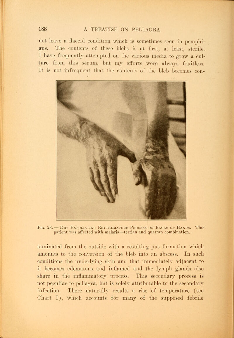 not leave a flaccid condition which is sometimes seen in pemphi- gus. The contents of these blebs is at first, at least, sterile. I have frequently attempted on the various media to grow a cul- ture from this serum, but my efforts were always fruitless. It is not infrequent that the contents of the bleb becomes con- Fig. 23. — Dry Exfoliating Erythematous Process on Backs of Hands. This patient was affected with malaria—tertian and quartan combination. taminated from the outside with a resulting- pus formation which amounts to the conversion of the bleb into an abscess. In such conditions the underlying skin and that immediately adjacent to it becomes edematous and inflamed and the lymph glands also share in the inflammatory process. This secondary process is not peculiar to pellagra, but is solely attributable to the secondary infection. There naturally results a rise of temperature (see Chart I), which accounts for many of the supposed febrile