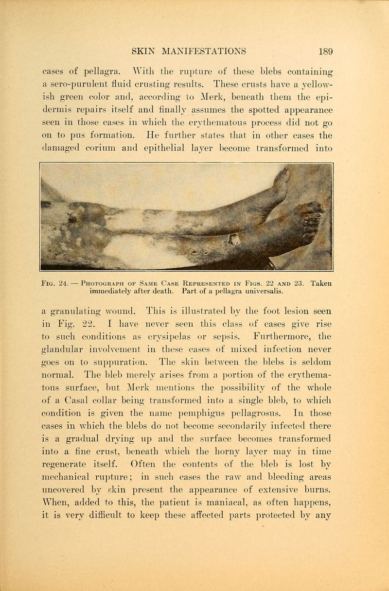 cases of pellagra. With the rupture of these blebs containing a sero-purulent fluid crusting results. These crusts have a yellow- ish green color and, according to Merk, beneath them the epi- dermis repairs itself and finally assumes the spotted appearance seen in those cases in which the erythematous process did not go on to pus formation. He further states that in other cases the damaged corium and epithelial layer become transformed into Fig. 24. — Photograph of Same Case Represented in Figs. 22 and 23. Taken immediately after death. Part of a pellagra universalis. a granulating wound. This is illustrated by the foot lesion seen in Fig. 22. I have never seen this class of cases give rise to such conditions as erysipelas or sepsis. Furthermore, the glandular involvement in these cases of mixed infection never goes on to suppuration. The skin between the blebs is seldom normal. The bleb merely arises from a portion of the erythema- tous surface, but Merk mentions the possibility of the whole of a Casal collar being transformed into a single bleb, to which condition is given the name pemphigus pellagrosus. In those cases in which the blebs do not become secondarily infected there is a gradual drying up and the surface becomes transformed into a fine crust, beneath which the horny layer may in time regenerate itself. Often the contents of the bleb is lost by mechanical rupture; in such cases the raw and bleeding areas uncovered by skin present the appearance of extensive burns. When, added to this, the patient is maniacal, as often happens, it is very difficult to keep these affected parts protected by any