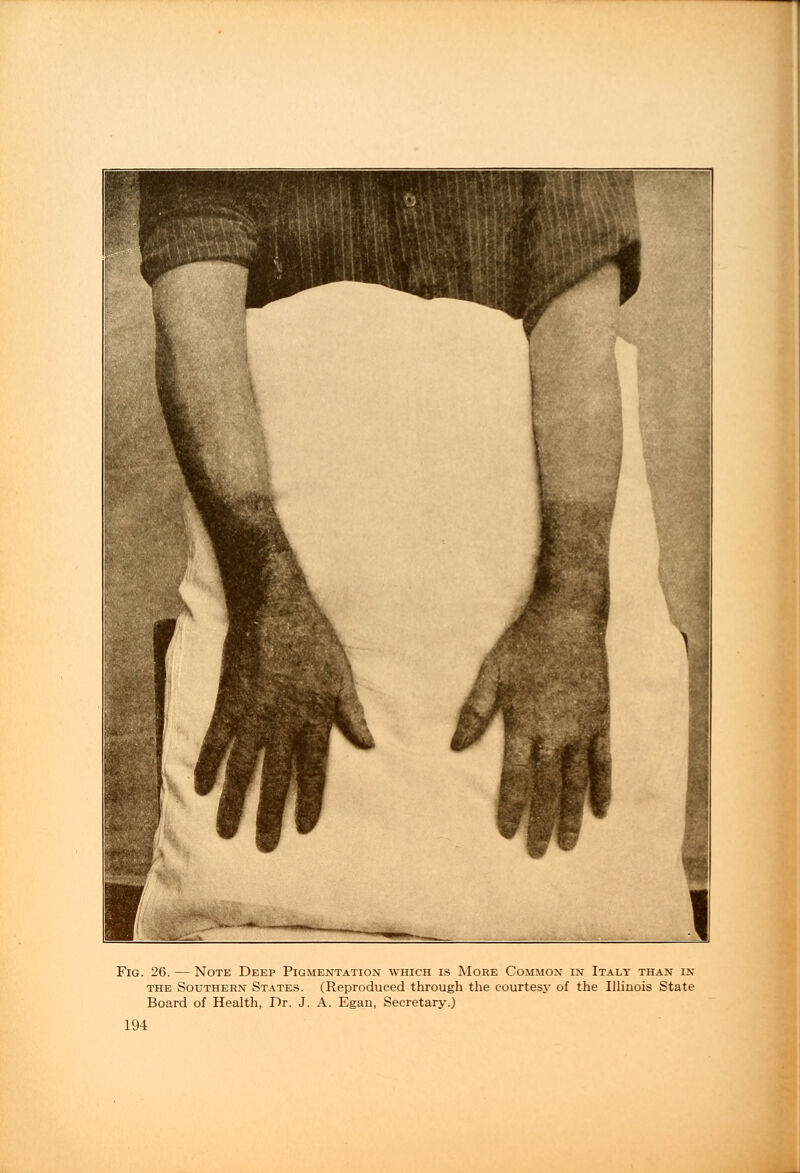 Fig. 26. — Note Deep Pigmentation which is More Common in Italy than in the Southern States. (Reproduced through the courtesy of the Illinois State Board of Health, Dr. J. A. Egan, Secretary.)