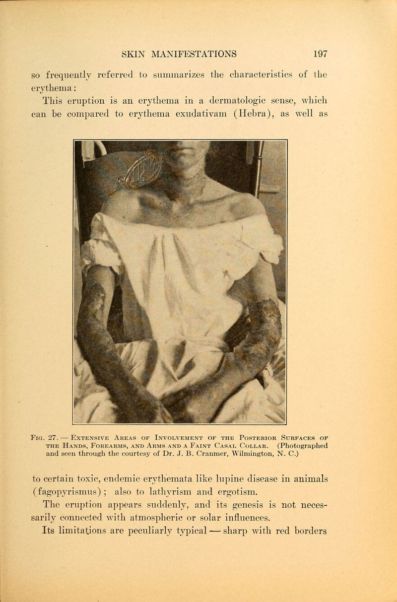 so frequently referred to summarizes the characteristics of the erythema: This eruption is an erythema in a dermatologic sense, which can be compared to erythema exudativam (Hebra), as well as Fig. 27. — Extensive Areas of Involvement of the Posterior Surfaces of the Hands, Forearms, and Arms and a Faint Casal Collar. (Photographed and seen through the courtesy of Dr. J. B. Cranmer, Wilmington, N. C.) to certain toxic, endemic erythemata like lupine disease in animals (fagopyrismus) ; also to lathyrism and ergotism. The eruption appears suddenly, and its genesis is not neces- sarily connected with atmospheric or solar influences. Its limitations are peculiarly typical — sharp with red borders