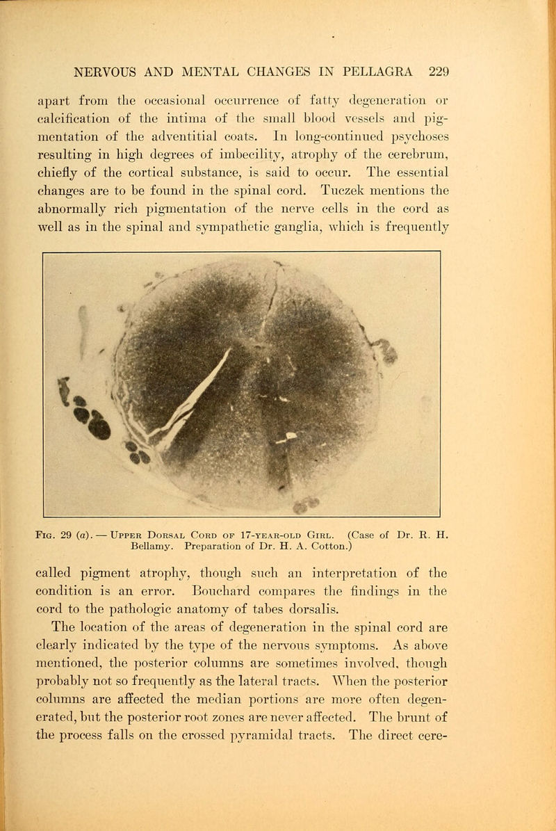 apart from the occasional occurrence of fatty degeneration or calcification of the intima of the small blood vessels and pig- mentation of the adventitial coats. In long-continued psychoses resulting in high degrees of imbecility, atrophy of the cerebrum, chiefly of the cortical substance, is said to occur. The essential changes are to be found in the spinal cord. Tuczek mentions the abnormally rich pigmentation of the nerve cells in the cord as well as in the spinal and sympathetic ganglia, which is frequently M &\ I ■;;<■■ <:,. ;. Hk^lr i% »Fji 1; ^^jB •. .../- m }fe ' Fig. 29 (a). — Upper Dorsal Cord of 17-year-old Girl. (Case of Dr. R. H. Bellamy. Preparation of Dr. H. A. Cotton.) called pigment atrophy, though such an interpretation of the condition is an error. Bouchard compares the findings in the cord to the pathologic anatomy of tabes dorsalis. The location of the areas of degeneration in the spinal cord are clearly indicated by the type of the nervous symptoms. As above mentioned, the posterior columns are sometimes involved, though probably not so frequently as the lateral tracts. When the posterior columns are affected the median portions are more often degen- erated, but the posterior root zones are never affected. The brunt of the process falls on the crossed pyramidal tracts. The direct cere-