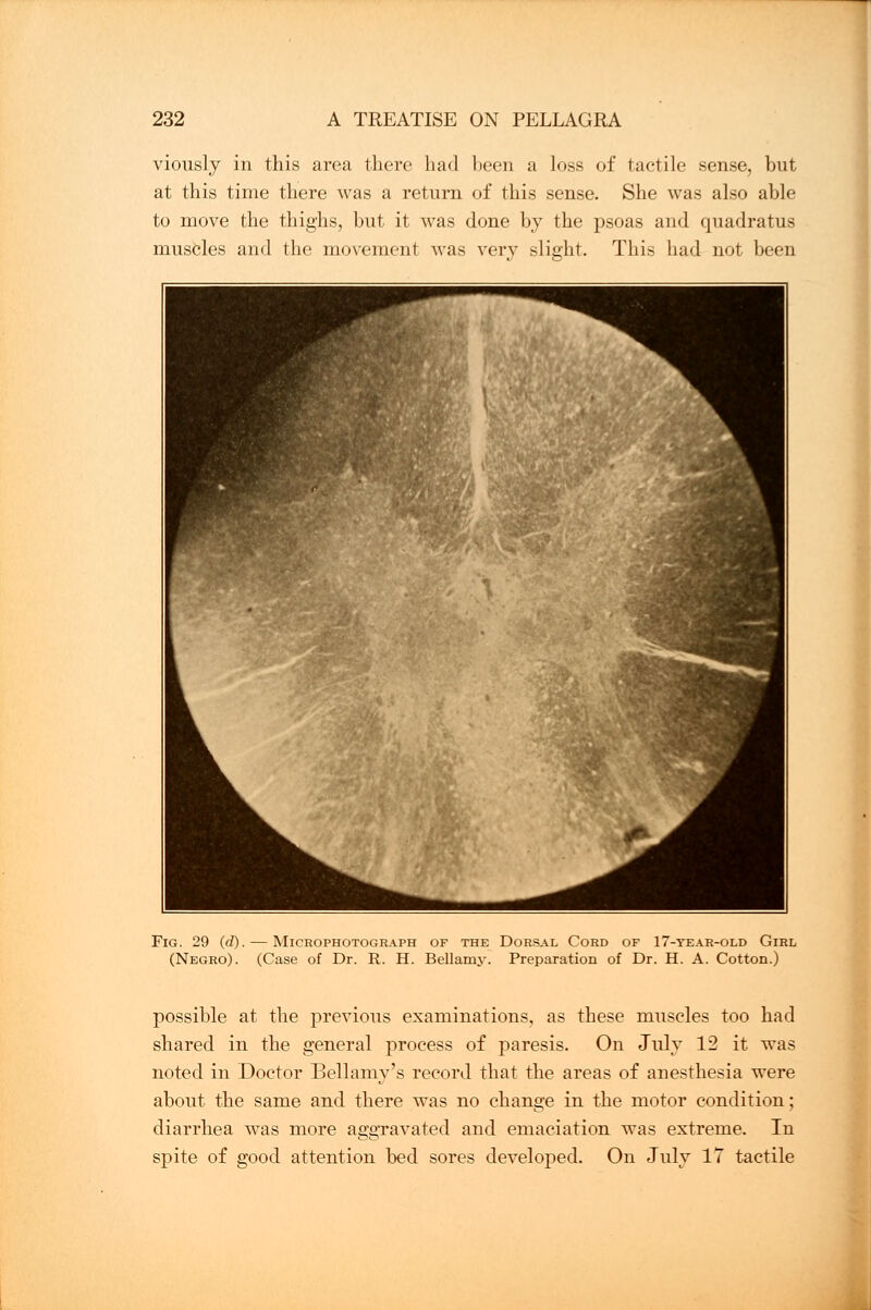 viously in this area there had been a loss of tactile sense, but at this time there was a return of this sense. She was also able to move the thighs, but it was done by the psoas and quadratus muscles and the movement was very slight. This had not been Fig. 29 (d). — Microphotograph of the Dorsal Cord of 17-year-old Girl (Negro). (Case of Dr. R. H. Bellamy. Preparation of Dr. H. A. Cotton.) possible at the previous examinations, as these muscles too had shared in the general process of paresis. On July 12 it was noted in Doctor Bellamy's record that the areas of anesthesia were about the same and there was no change in the motor condition; diarrhea was more aggravated and emaciation was extreme. In spite of good attention bed sores developed. On July 17 tactile