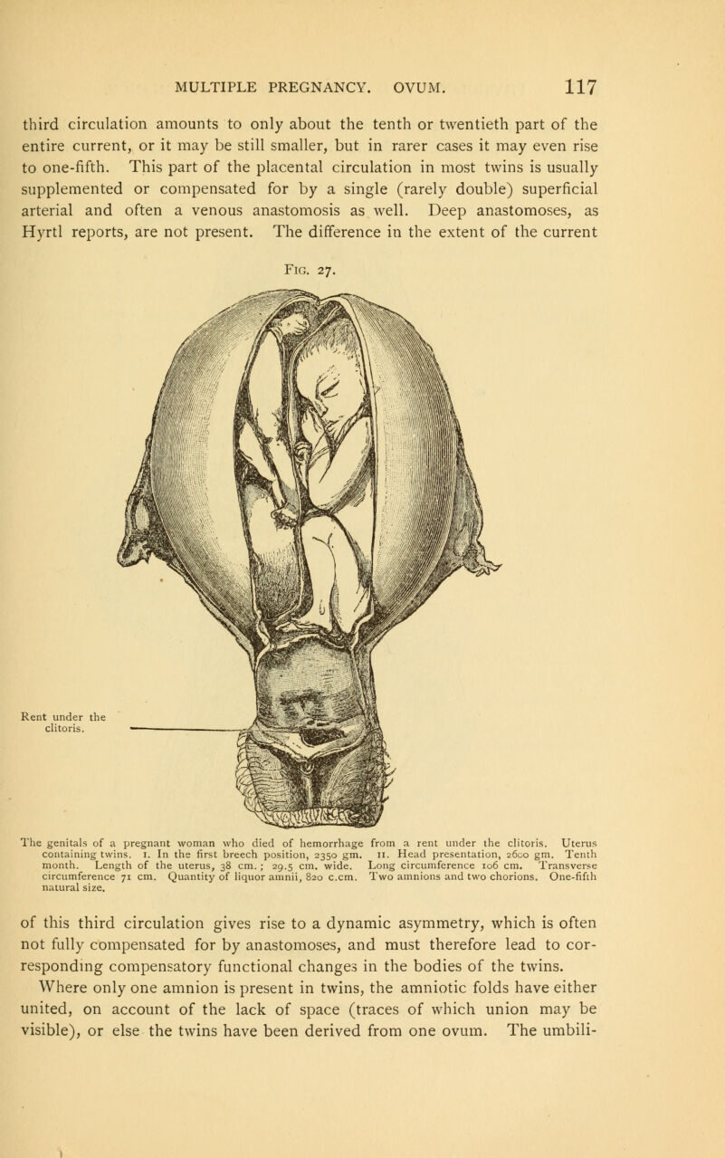 third circulation amounts to only about the tenth or twentieth part of the entire current, or it may be still smaller, but in rarer cases it may even rise to one-fifth. This part of the placental circulation in most twins is usually supplemented or compensated for by a single (rarely double) superficial arterial and often a venous anastomosis as well. Deep anastomoses, as Hyrtl reports, are not present. The difference in the extent of the current Fig. 27. Rent under the clitoris. The genitals of a pregnant woman who died of hemorrhage from a rent under the clitoris. Uterus containing twins. 1. In the first breech position, 2350 gm. n. Head presentation, 2600 gm. Tenth month. Length of the uterus, 38 cm.; 29.5 cm. wide. Long circumference 106 cm. Transverse circumference 71 cm. Quantity of liquor amnii, 820 c.cm. Two amnions and two chorions. One-fifth natural size. of this third circulation gives rise to a dynamic asymmetry, which is often not fully compensated for by anastomoses, and must therefore lead to cor- responding compensatory functional changes in the bodies of the twins. Where only one amnion is present in twins, the amniotic folds have either united, on account of the lack of space (traces of which union may be visible), or else the twins have been derived from one ovum. The umbili-