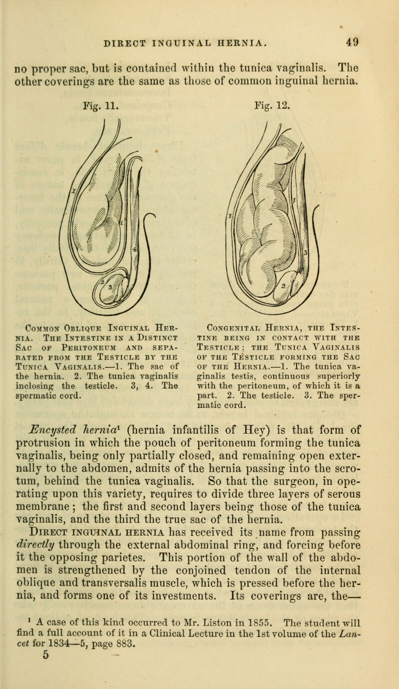 no proper sac, but is contained within the tunica vaginalis. The other coverings are the sanae as those of common inguinal hernia. Fig. 11. Common Oblique Ingttinal Her- nia. The Intestine in a Distinct Sac of Peritoneum and sepa- rated FROM the Testicle by the Tunica Vaginalis.—1. The sac of the hernia. 2. The tunica vaginalis inclosing the testicle. 3, 4. The spermatic cord. Fig. 12. Congenital Hernia, the Intes- tine BEING IN CONTACT WITH THE Testicle ; the Tunica Vaginalis OF the Testicle forming the Sac OF the Hernia.—1. The tunica va- ginalis testis, continuous superiorly with the peritoneum, of which it is a part. 2. The testicle. 3. The sper- matic cord. Encysted hernia^ (hernia infantilis of Hey) is that form of protrusion in which the pouch of peritoneum forming the tunica vaginalis, being only partially closed, and remaining open exter- nally to the abdomen, admits of the hernia passing into the scro- tum, behind the tunica vaginalis. So that the surgeon, in ope- rating upon this variety, requires to divide three layers of serous membrane; the first and second layers being those of the tunica vaginalis, and the third the true sac of the hernia. Direct inguinal hernia has received its name from passing directly through the external abdominal ring, and forcing before it the opposing parietes. This portion of the wall of the abdo- men is strengthened by the conjoined tendon of the internal oblique and transversalis muscle, which is pressed before the her- nia, and forms one of its investments. Its coverings are, the— ' A case of this kind occurred to Mr. Liston in 1855. Tlie student will find a full account of it in a Clinical Lecture in the 1st volume of the Lan- cet for 1834—5, page 883. 5