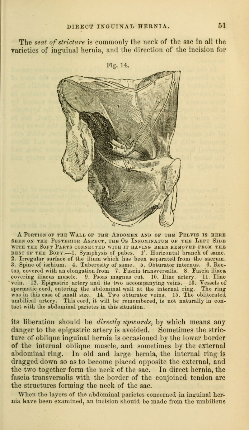 The seat of stricture is commonly tlie neck of the sac in all the varieties of inguinal hernia, and the direction of the incision for Fig. 14. A Portion op the Wall of the Abdomen and of the Pelvis is here SEEN on the Posterior Aspect, the Os Innojiinatum of the Left Side WITH THE Soft Parts connected with it having been removed from the rest of the Body.—1. Symphysis of pubes. 1'. Horizontal branch of same. 2. Irregular surface of the ilium which has been separated from the sacrum. 3. Spine of ischium. 4. Tuberosity of same. 5. Obturator internus. 6. Rec- tus, covered with an elongation from 7. Fascia transversalis. 8. Fascia iliaca covering iliacus muscle. 9. Psoas magnus cut. 10. Iliac artery. 11. Iliac vein. 12. Epigastric artery and its two accompanying veins. 13. Vessels of spermatic cord, entering the abdominal wall at the internal ring. The ring was in this case of small size. 14. Two obturator veins. 15. The obliterated umbilical artery. This coi'd, it will be remembered, is not naturally in con- tact with the abdominal parietes in this situation. its liberation should be directly upwards, by which means any danger to the epigastric artery is avoided. Sometimes the stric- ture of oblique inguinal hernia is occasioned by the lower border of the internal oblique muscle, and sometimes by the external abdominal ring. In old and large hernia, the internal ring is dragged down so as to become placed opposite the external, and the two together form the neck of the sac. In direct hernia, the fascia transversalis with the border of the conjoined tendon are the structures forming the neck of the sac. When the layers of the abdominal parietes concerned in inguinal her- nia have been examined, an incision should be made from the umbilicus