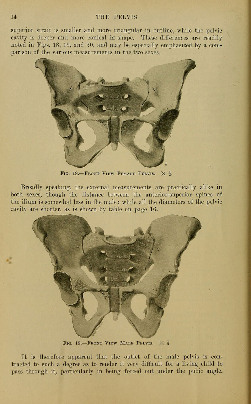 superior strait is smaller and more triangular in outline, while the pelvic cavity is deeper and more conical in shape. These differences are readily noted in Figs. 18, 19, and 20, and may be especially emphasized by a com- parison of the various measurements in the two sexes. Fig. 18.—Front View Female Pelvis. X f. Broadly speaking, the external measurements are practically alike in both sexes, though the distance between the anterior-superior spines of the ilium is somewhat less in the male; while all the diameters of the pelvic cavity are shorter, as is shown by table on page 16. Fig. 19.—Front View Male Pelvis. X 3 It is therefore apparent that the outlet of the male pelvis is con- tracted to such a degree as to render it very difficult for a living child to pass through it, particularly in being forced out under the pubic angle.