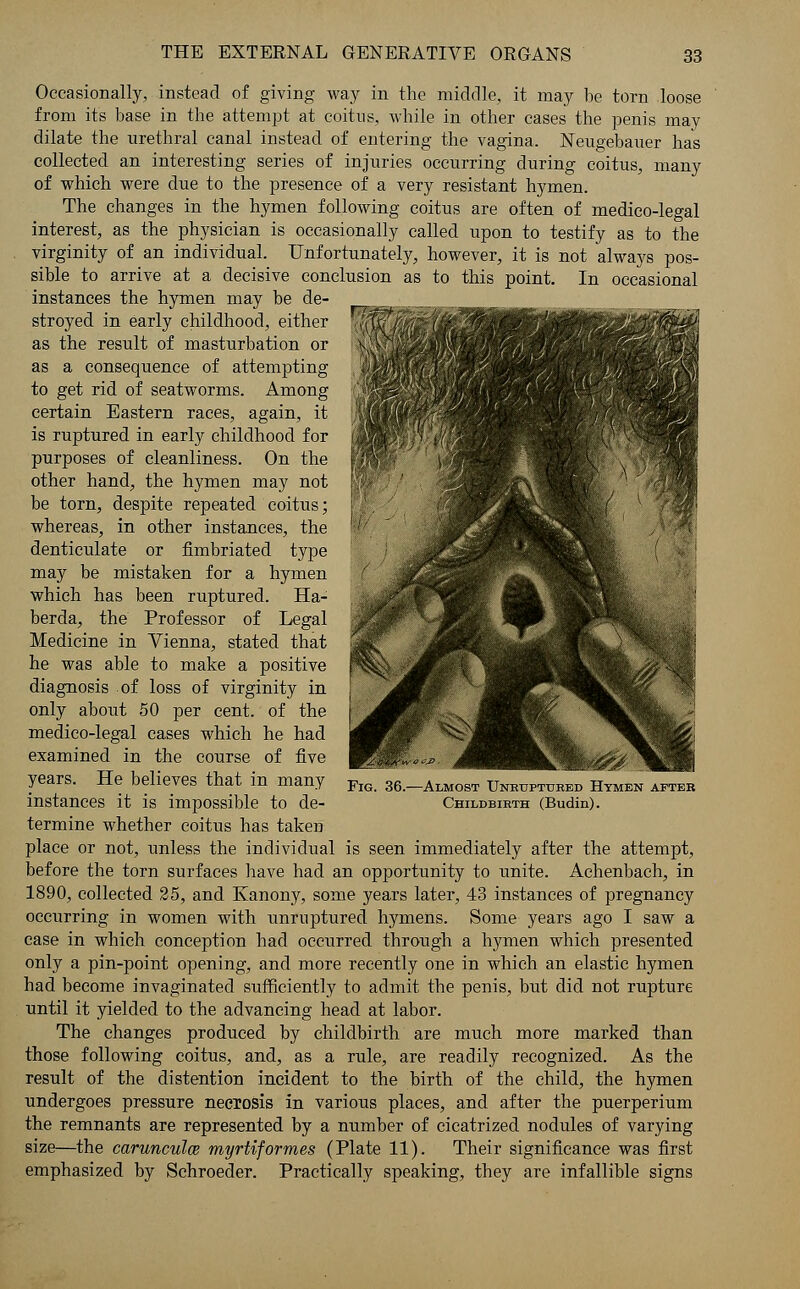 Occasionally, instead of giving way in the middle, it may be torn loose from its base in the attempt at coitus, while in other cases the penis may dilate the urethral canal instead of entering the vagina. Neugebauer has collected an interesting series of injuries occurring during coitus, many of which were due to the presence of a very resistant hymen. The changes in the hymen following coitus are often of medico-legal interest, as the physician is occasionally called upon to testify as to the virginity of an individual. Unfortunately, however, it is not always pos- sible to arrive at a decisive conclusion as to this point. In occasional instances the hymen may be de- stroyed in early childhood, either as the result of masturbation or as a consequence of attempting to get rid of seatworms. Among certain Eastern races, again, it is ruptured in early childhood for purposes of cleanliness. On the other hand, the hymen may not be torn, despite repeated coitus; whereas, in other instances, the denticulate or fimbriated type may be mistaken for a hymen which has been ruptured. Ha- berda, the Professor of Legal Medicine in Vienna, stated that he was able to make a positive diagnosis of loss of virginity in only about 50 per cent, of the medico-legal cases which he had examined in the course of five years. He believes that in many instances it is impossible to de- termine whether coitus has taken place or not, unless the individual is seen immediately after the attempt, before the torn surfaces have had an opportunity to unite. Achenbach, in 1890, collected 25, and Kanony, some years later, 43 instances of pregnancy occurring in women with unruptured hymens. Some years ago I saw a case in which conception had occurred through a hymen which presented only a pin-point opening, and more recently one in which an elastic hymen had become invaginated sufficiently to admit the penis, but did not rupture until it yielded to the advancing head at labor. The changes produced by childbirth are much more marked than those following coitus, and, as a rule, are readily recognized. As the result of the distention incident to the birth of the child, the hymen undergoes pressure necrosis in various places, and after the puerperium the remnants are represented by a number of cicatrized nodules of varying size—the carunculce myrtiformes (Plate 11). Their significance was first emphasized by Schroeder. Practically speaking, they are infallible signs Fig. 36.—Almost Unruptured Hymen after Childbirth (Budin).