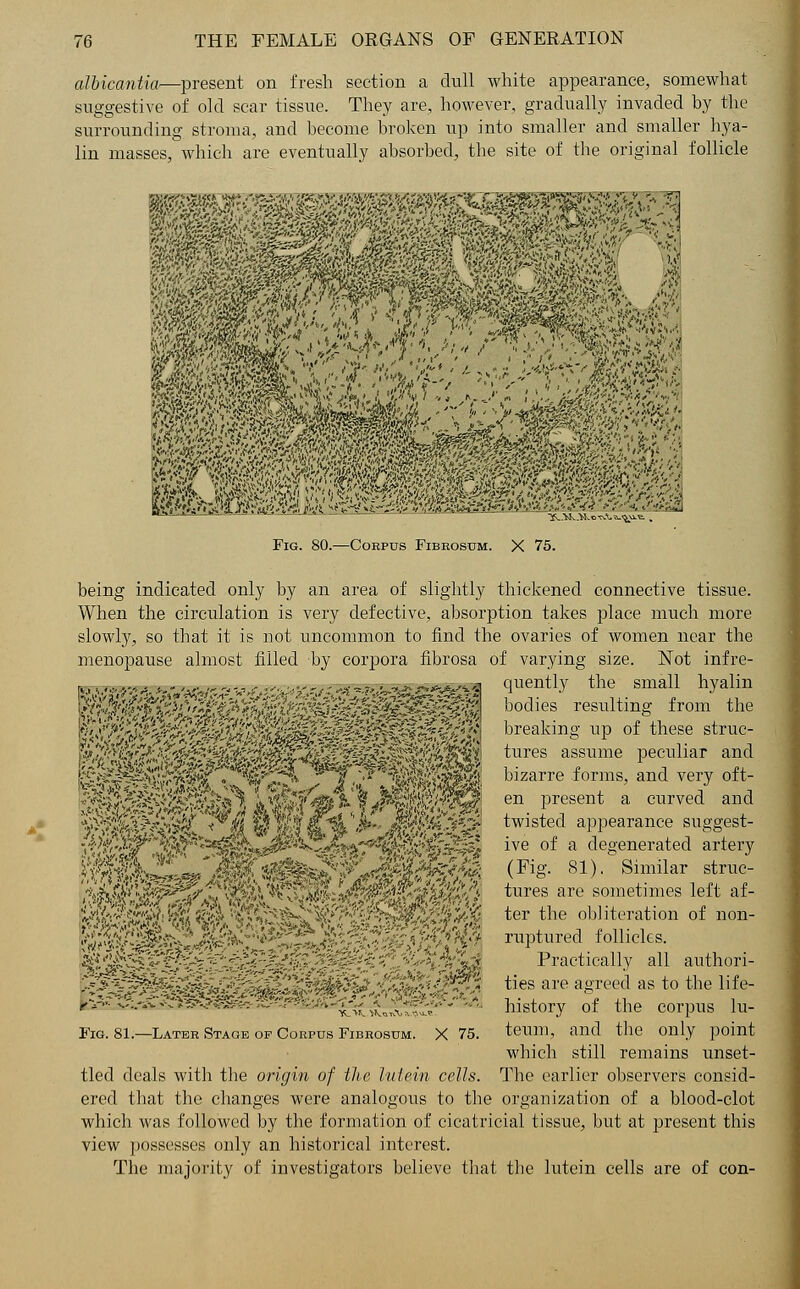 albicantia—present on fresh section a dull white appearance, somewhat suggestive of old scar tissue. They are, however, gradually invaded by the surrounding stroma, and become broken up into smaller and smaller hya- lin masses, which are eventually absorbed, the site of the original follicle % mm. '  1 mfz Fig. 80.—Corpus Fibhosum. X 75. being indicated only by an area of slightly thickened connective tissue. When the circulation is very defective, absorption takes place much more slowly, so that it is not uncommon to find the ovaries of women near the menopause almost filled by corpora fibrosa of varying size. Not infre- s .-,~ , „,,. ,„„,., .„„_-. ■** ■***&*& quently the small hyalin : ■< /. : . ■■.,■' ' ■■ '•'..-■ ,■■.■■.•.-.,;.■...• ■■ ■..■■:■■ ■■..• ■ . ■ .■ /-—. ^ ■'■ ■ ,.■■'..; -?4$£$\:£'0jZ ft *A9 a bodies resulting from the breaking up of these struc- tures assume peculiar and bizarre forms, and very oft- en present a civrved and twisted appearance suggest- ive of a degenerated artery (Fig. 81). Similar struc- tures are sometimes left af- ter the obliteration of non- ruptured follicles. Practically all authori- ties are agreed as to the life- history of the corpus lu- which still remains unset- tled deals with the origin of the lutein cells. The earlier observers consid- ered that the changes were analogous to the organization of a blood-clot which was followed by the formation of cicatricial tissue, but at present this view possesses only an historical interest. The majority of investigators believe that the lutein cells are of con-