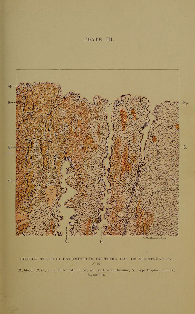 PLATE III. fc -V • v '■;;.-?f' - •* .... .*>, rv:,-',-;:.^..^ B.G.-— ■■ .«••- '- _. SECTION THROUGH ENDOMETRIUM ON THIRD DAY OF MENSTRUATION. 7?., blood; E.G., gland filled with blood; JEp., surface epitlielium; <?., liypertrophied glands