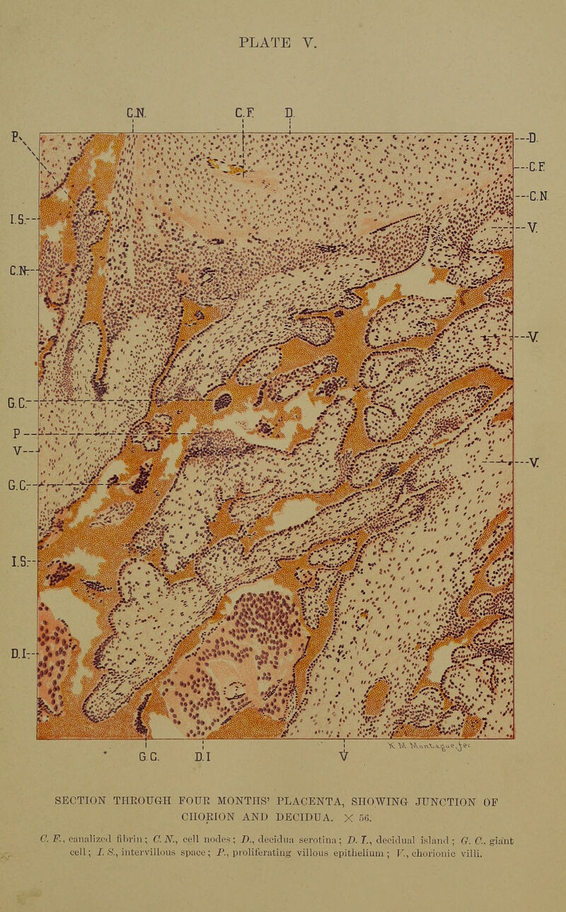 C.N. C.F *.W \A.=iA.&.^e.,$e SECTION THROUGH FOUR MONTHS' PLACENTA, SHOWING JUNCTION OP CHORION AND DECIDUA. X 56. C. F., canalized fibrin; C.N., ceil nodes; D., deeidun serotina; D. 7\, decidual island ; G. <:. giant cell; Z &, intervillous space; P., proliferating villous epithelium; V., chorionic villi.
