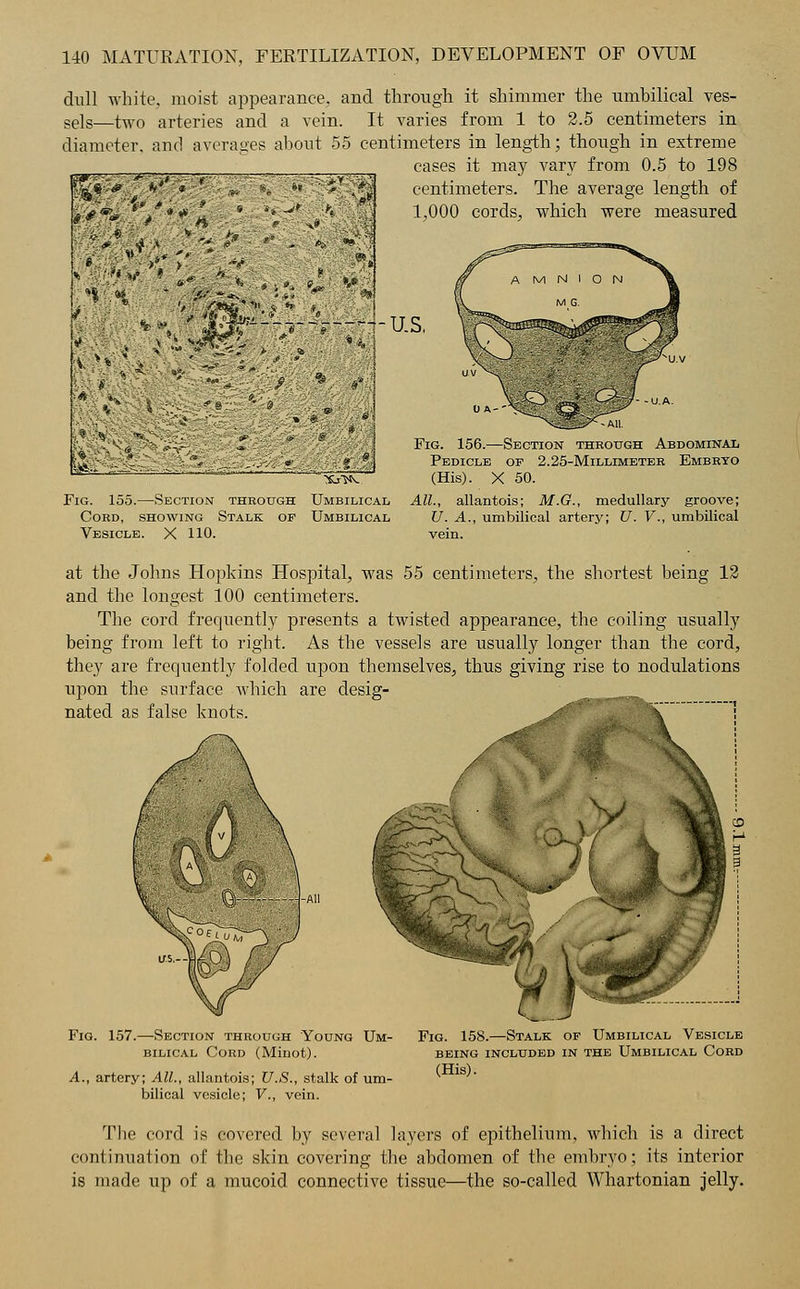 dull white, moist appearance, and through it shimmer the umbilical ves- sels—two arteries and a vein. It varies from 1 to 2.5 centimeters in diameter, and averages about 55 centimeters in length; though in extreme cases it may vary from 0.5 to 198 *■! S&**'4 sJi centimeters. 1,000 cords, The average length of which were measured mm m- us, Fig. 155.—Section through Umbilical Cord, showing Stalk of Umbilical Vesicle. X 110. Fig. 156.—Section through Abdominal Pedicle of 2.25-Millimeter Embryo (His). X 50. All., allantois; M.G., medullary groove; U. A., umbilical artery; U. V., umbilical vein. at the Johns Hopkins Hospital, was 55 centimeters, the shortest being 12 and the longest 100 centimeters. The cord frequently presents a twisted appearance, the coiling usually being from left to right. As the vessels are usually longer than the cord, they are frequently folded upon themselves, thus giving rise to nodulations upon the surface which are nated as false knots. Fig. 157.—Section through Young Um- bilical Cord (Minot). A., artery; All., allantois; U.S., stalk of um- bilical vesicle; V., vein. Fig. 158.—Stalk of Umbilical Vesicle being included in the Umbilical Cord (His). The cord is covered by several layers of epithelium, which is a direct continuation of the skin covering the abdomen of the embryo; its interior is made up of a mucoid connective tissue—the so-called Whartonian jelly.