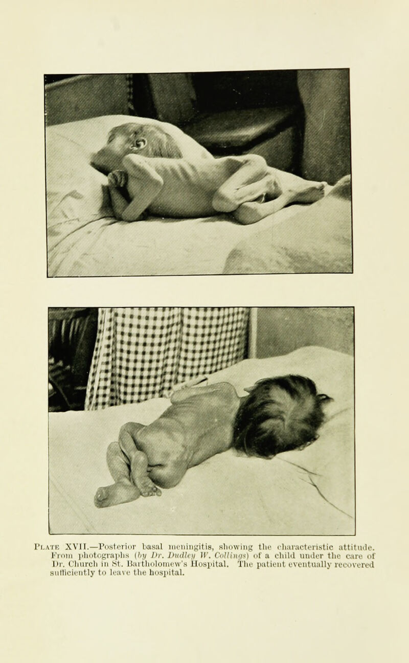 • ••••• «♦'? >IIMl' \ V S Plate XVII.—Posterior basal meningitis, showing the characteristic attitude. From photographs (by Dr. Dudley If. Collings) of a child under the care of Dr. Church in St. Bartholomew's Hospital. The patient eventually recovered sufficiently to leave the hospital.