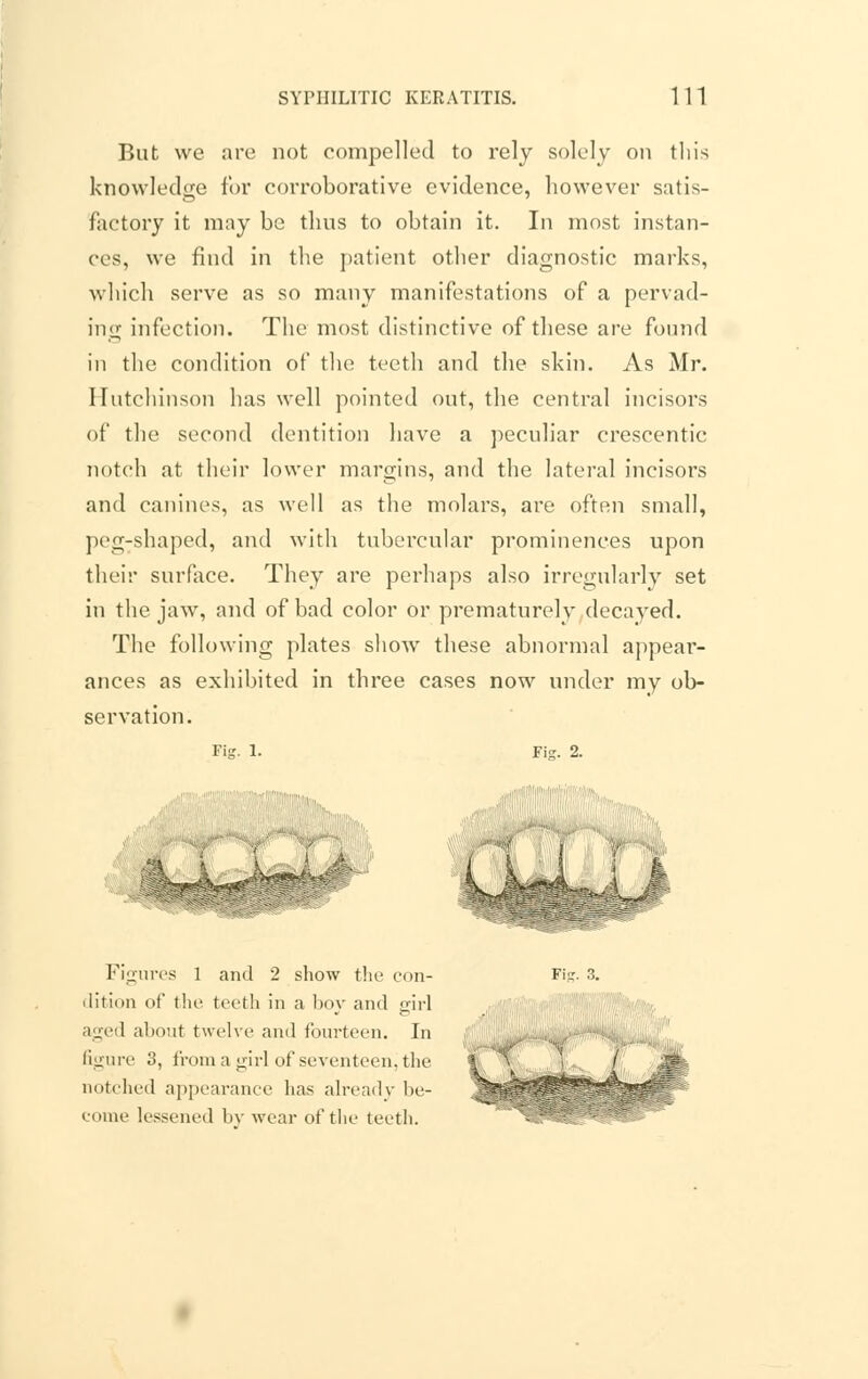 But we are not compelled to rely solely on this knowledge for corroborative evidence, however satis- factory it may be thus to obtain it. In most instan- ces, we find in the patient other diagnostic marks, which serve as so many manifestations of a pervad- ing infection. The most distinctive of these are found in the condition of the teeth and the skin. As Mr. Hutchinson has well pointed out, the central incisors of the second dentition have a peculiar crescentic notch at their lower margins, and the lateral incisors and canines, as well as the molars, are often small, peg-shaped, and with tubercular prominences upon their surface. They are perhaps also irregularly set in the jaw, and of bad color or prematurely decayed. The following plates show these abnormal appear- ances as exhibited in three cases now under my ob- servation. Fig. 1. Fisr. 2. ' I I Figures 1 and 2 show the con- dition of the teeth in a boy and girl aged about twelve and fourteen. In figure 3, from a girl of seventeen! the notched appearance has already be- come lessened liv wear of the teeth. Ffc. 3.