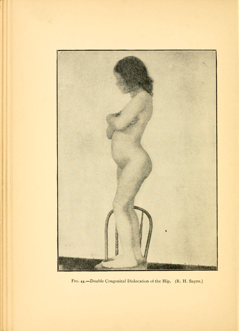 Fig. 44.—Double Congenital Dislocation of the Hip. (R. H. Sayre.)