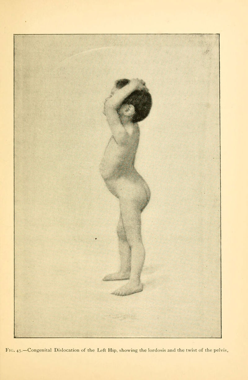 Fig. 45.—Congenita] Dislocation of the Left Hip. showing the lordosis and the twist of the pelvis