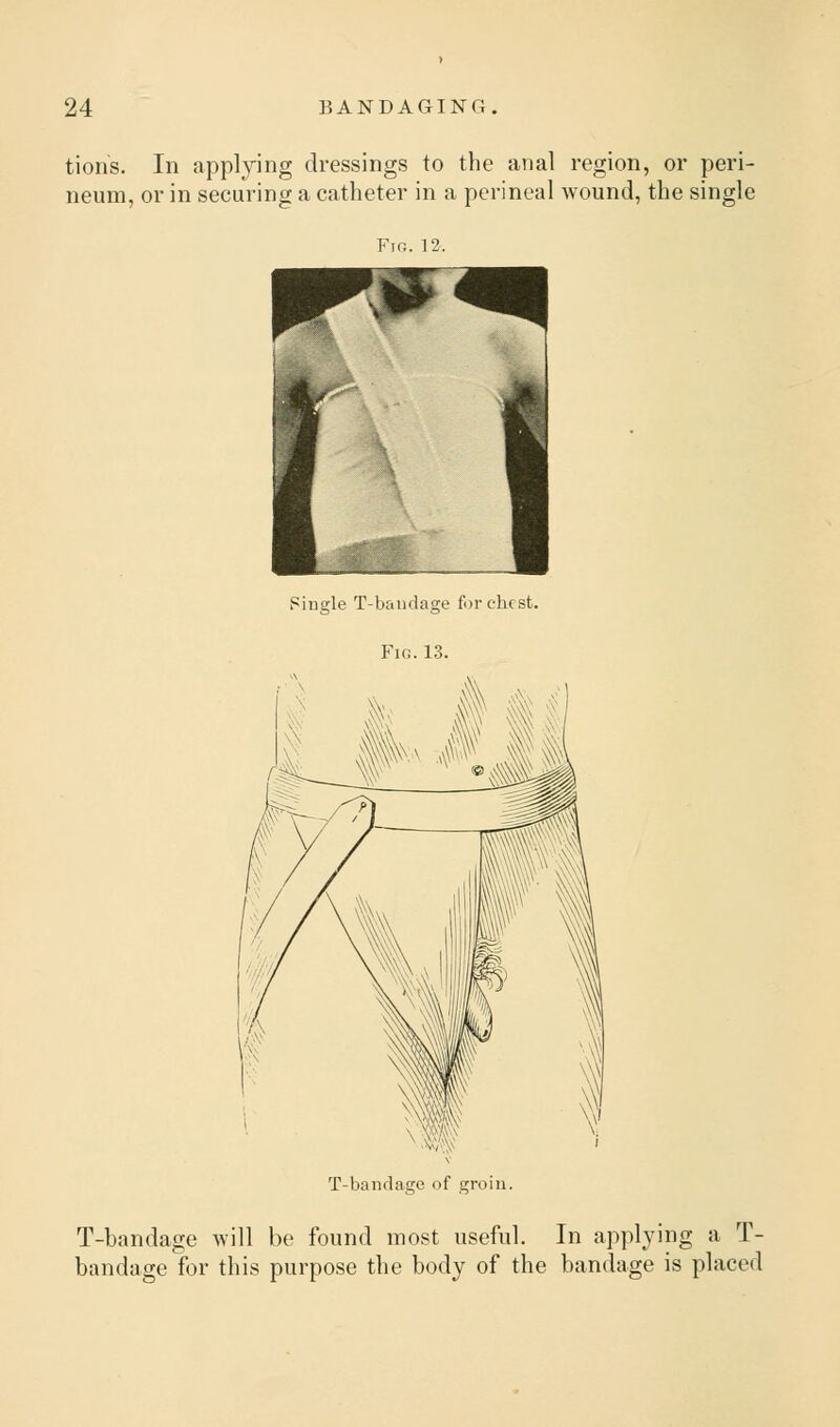 tioris. In applying dressings to the anal region, or peri- neum, or in securing a catheter in a perineal wound, the single Fig. 12. Single T-baudage for chest. Fig. 13. sssf T-bandage of groin. T-bandage will be found most useful. In applying a T- bandage for this purpose the body of the bandage is placed