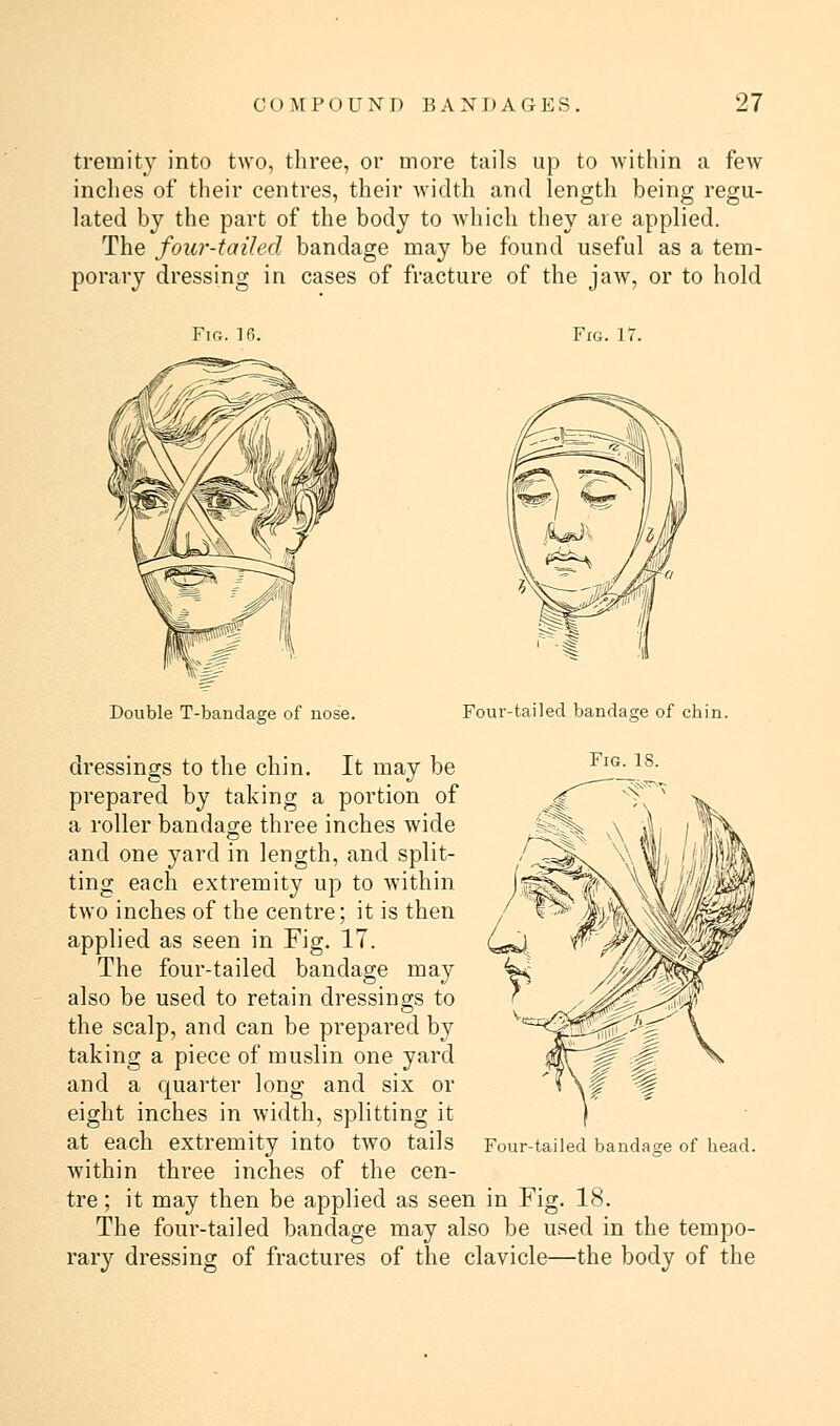 tremity into two, three, or more tails up to within a few inches of their centres, their width and length being regu- lated by the part of the body to which they are applied. The four-tailed bandage may be found useful as a tem- porary dressing in cases of fracture of the jaw, or to hold Fig. 1 Fig. 17. Double T-bandage of nose. Four-tailed bandage of chin. Fig. IS. dressings to the chin. It may be prepared by taking a portion of a roller bandage three inches wide and one yard in length, and split- ting each extremity up to within two inches of the centre; it is then applied as seen in Fig. 17. The four-tailed bandage may also be used to retain dressings to the scalp, and can be prepared by taking a piece of muslin one yard and a quarter long and six or eight inches in width, splitting it at each extremity into two tails within three inches of the cen- tre ; it may then be applied as seen in Fig. 18. The four-tailed bandage may also be used in the tempo- rary dressing of fractures of the clavicle—the body of the Four-tailed bandage of head.