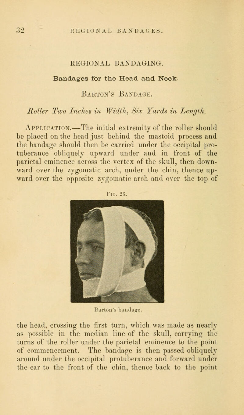 REGIONAL BANDAGING. Bandages for the Head and Neck. Barton's Bandage. Holler Tivo Inches in Width, Six Yards in Length. Application.—The initial extremity of the roller should be placed on the head just behind the mastoid process and the bandage should then be carried under the occipital pro- tuberance obliquely upward under and in front of the parietal eminence across the vertex of the skull, then down- ward over the zygomatic arch, under the chin, thence up- ward over the opposite zygomatic arch and over the top of Fig. 26. Barton's bandage. the head, crossing the first turn, which was made as nearly as possible in the median line of the skull, carrying the turns of the roller under the parietal eminence to the point of commencement. The bandage is then passed obliquely around under the occipital protuberance and forward under the ear to the front of the chin, thence back to the point