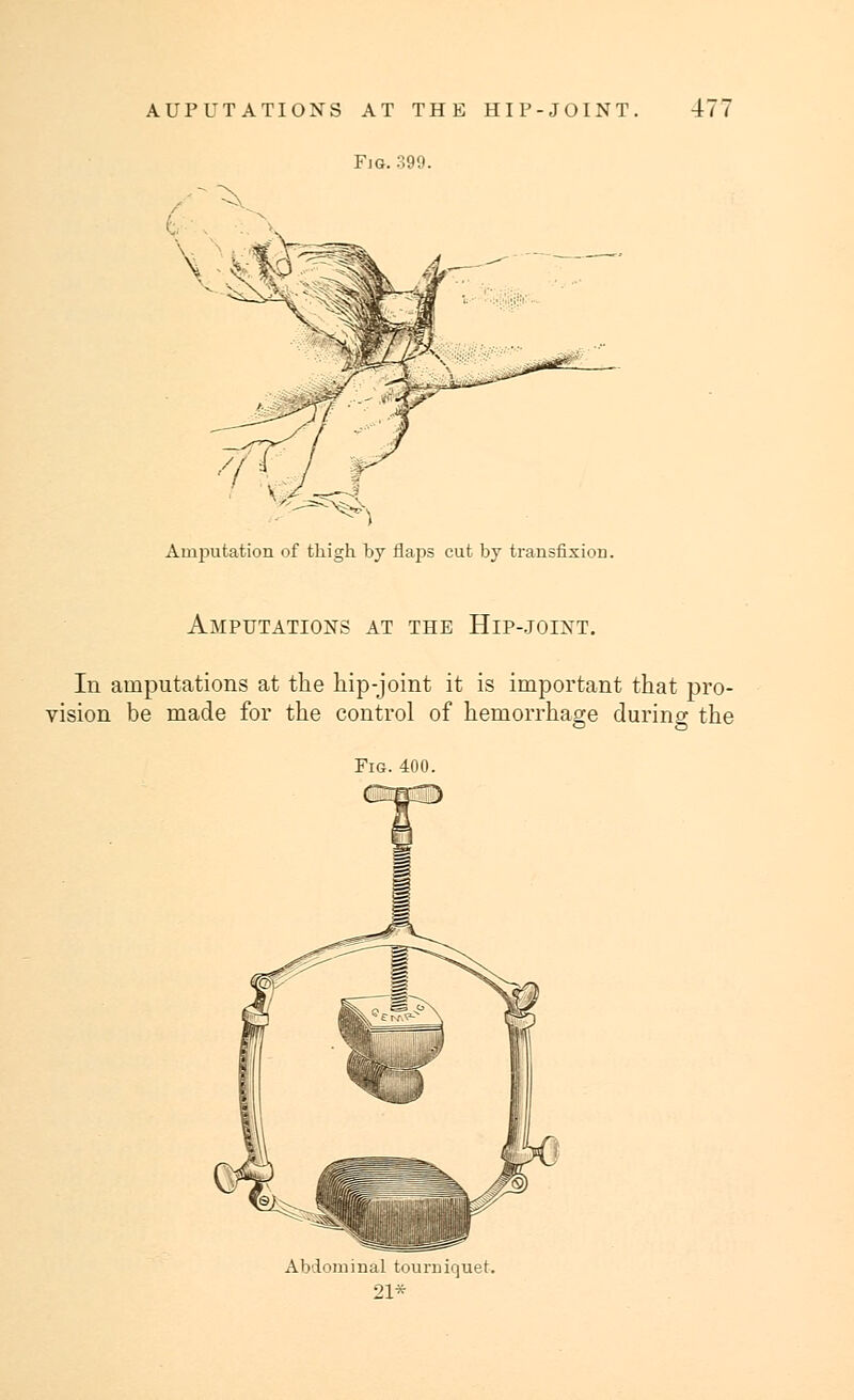 Fig. 399. Amputation of thigh by flaps cut by transfixion. Amputations at the Hip-joixt. In amputations at the hip-joint it is important that pro- vision be made for the control of hemorrhage during the Fig. 400. Abdominal tourniquet. 21*