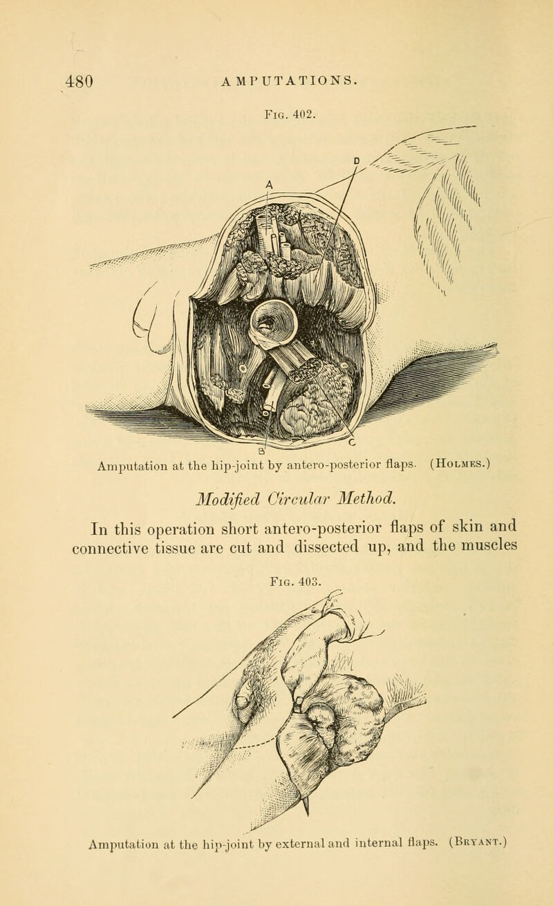 Fig. 402. Amputation at the hip-joint by antero-posterior flaps. (Holmes. Modified Circular Method. In this operation short antero-posterior flaps of skin and connective tissue are cut and dissected up, and the muscles Fig. 403. Amputation at the hip-joint by external and internal flaps. (Bryant.)