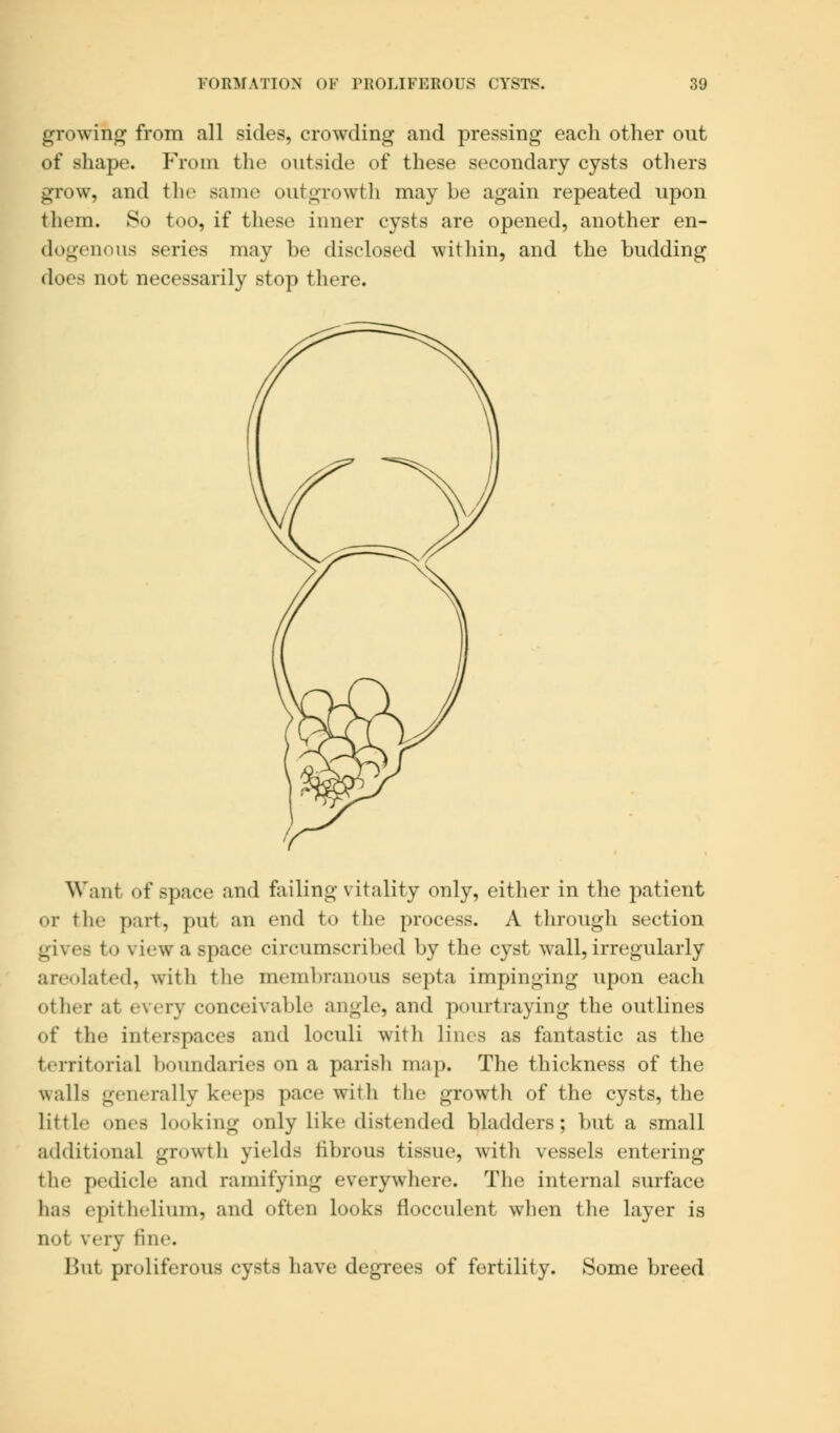 growing from all sides, crowding and pressing each other out of shape. From the outside of these secondary cysts others grow, and the same outgrowth maybe again repeated upon them. So too, if these inner cysts are opened, another en- dogenous series may be disclosed within, and the budding does not necessarily stop there. Want of space and failing vitality only, either in the patient or the part, put an end to the process. A through section gives to view a Bpace circumscribed by the cyst wall,irregularly areolated, with the membranous septa impinging upon each other at every conceivable angle, and pourtraying the outlines of the interspaces and Loculi with lines as fantastic as the territorial boundaries on a parish map. The thickness of the walls generally keeps pace with the growth of the cysts, the little ones looking only like distended bladders; but a small additional growth yields fibrous tissue, with vessels entering the pedicle and ramifying everywhere. The internal surface lias epithelium, and often looks flocculent when the layer is not very fine. Bui proliferous cysts have degrees of fertility. Some breed