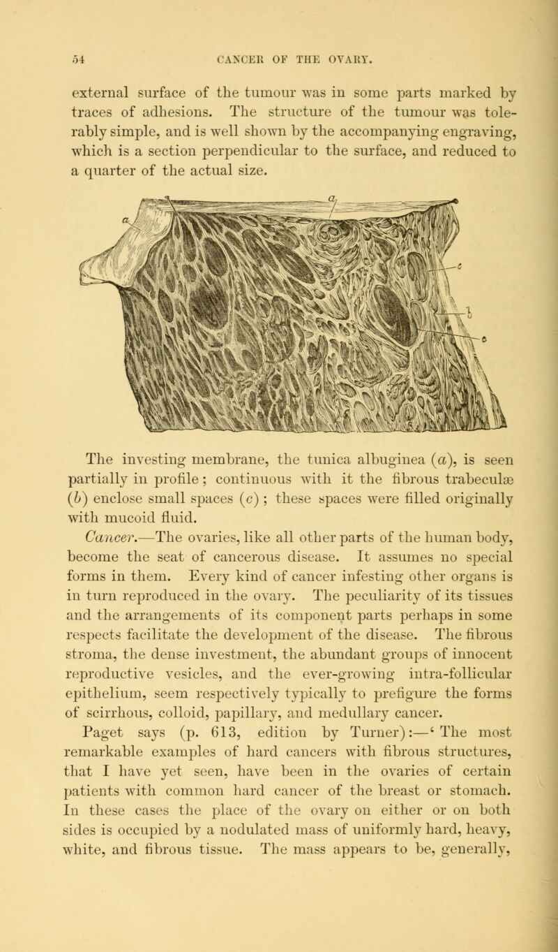 external surface of the tumour was in some parts marked by traces of adhesions. The structure of the tumour was tole- rably simple, and is well shown by the accompanying engraving, which is a section perpendicular to the surface, and reduced to a quarter of the actual size. The investing membrane, the tunica albuginea (ct), is seen partially in profile; continuous with it the fibrous trabeculae (b) enclose small spaces (c); these spaces were filled originally with mucoid fluid. Cancer.—The ovaries, like all other parts of the human body, become the seat of cancerous disease. It assumes no special forms in them. Every kind of cancer infesting other organs is in turn reproduced in the ovary. The peculiarity of its tissues and the arrangements of its component parts perhaps in some respects facilitate the development of the disease. The fibrous stroma, the dense investment, the abundant groups of innocent reproductive vesicles, and the ever-growing intra-follicular epithelium, seem respectively typically to prefigure the forms of scirrhous, colloid, papillary, and medullary cancer. Paget says (p. 613, edition by Turner):—'The most remarkable examples of hard cancers with fibrous structures, that I have yet seen, have been in the ovaries of certain patients with common hard cancer of the breast or stomach. In these cases the place of the ovary on either or on both sides is occupied by a nodulated mass of uniformly hard, heavy, white, and fibrous tissue. The mass appears to be, generally.