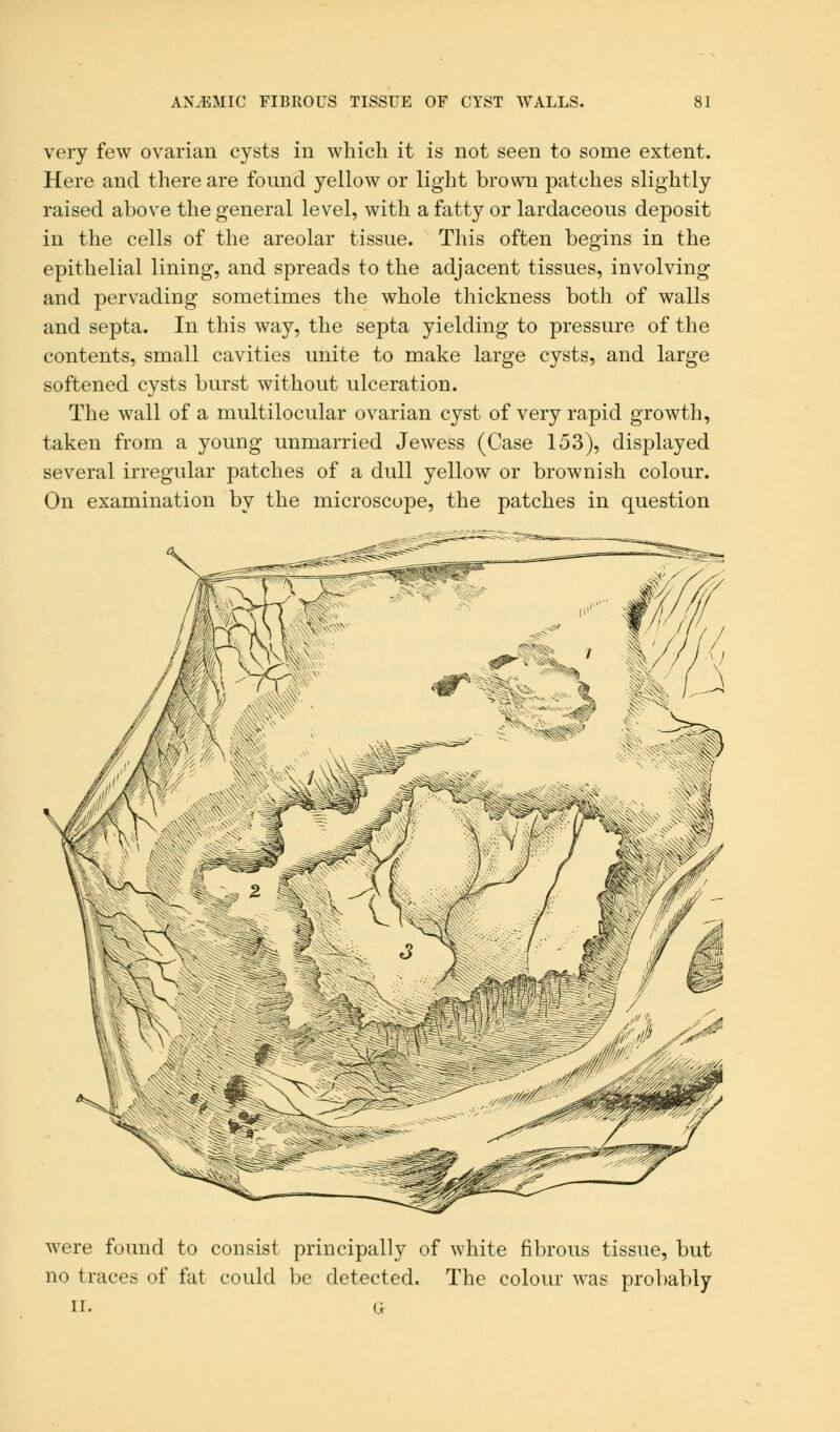 very few ovarian cysts in which it is not seen to some extent. Here and there are fonnd yellow or light brown patches slightly raised above the general level, with a fatty or lardaceous deposit in the cells of the areolar tissue. This often begins in the epithelial lining, and spreads to the adjacent tissues, involving and pervading sometimes the whole thickness both of walls and septa. In this way, the septa yielding to pressure of the contents, small cavities unite to make large cysts, and large softened cysts burst without ulceration. The wall of a multilocular ovarian cyst of very rapid growth, taken from a young unmarried Jewess (Case 153), displayed several irregular patches of a dull yellow or brownish colour. On examination by the microscope, the patches in question were found to consist principally of white fibrous tissue, but no traces of fat could be detected. The colour was probably II. G