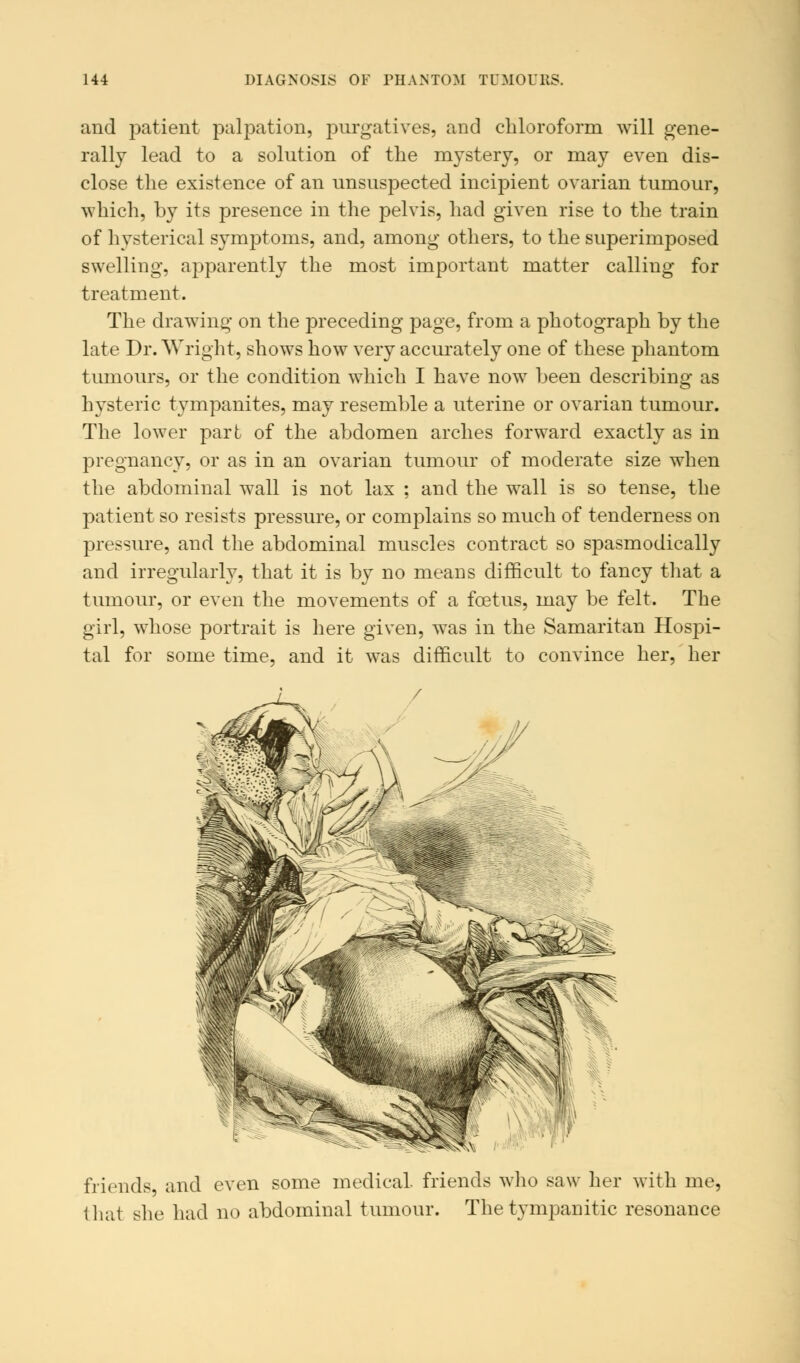 and patient palpation, purgatives, and chloroform will gene- rally lead to a solution of the mystery, or may even dis- close the existence of an unsuspected incipient ovarian tumour, which, by its presence in the pelvis, had given rise to the train of hysterical symptoms, and, among others, to the superimposed swelling, apparently the most important matter calling for treatment. The drawing on the preceding page, from a photograph by the late Dr. Wright, shows how very accurately one of these phantom tumours, or the condition which I have now been describing as hysteric tympanites, may resemble a uterine or ovarian tumour. The lower part of the abdomen arches forward exactly as in pregnancy, or as in an ovarian tumour of moderate size when the abdominal wall is not lax ; and the wall is so tense, the patient so resists pressure, or complains so much of tenderness on pressure, and the abdominal muscles contract so spasmodically and irregularly, that it is by no means difficult to fancy that a tumour, or even the movements of a foetus, may be felt. The girl, whose portrait is here given, was in the Samaritan Hospi- tal for some time, and it was difficult to convince her, her friends, and even some medical, friends who saw her with me, that she had no abdominal tumour. The tympanitic resonance