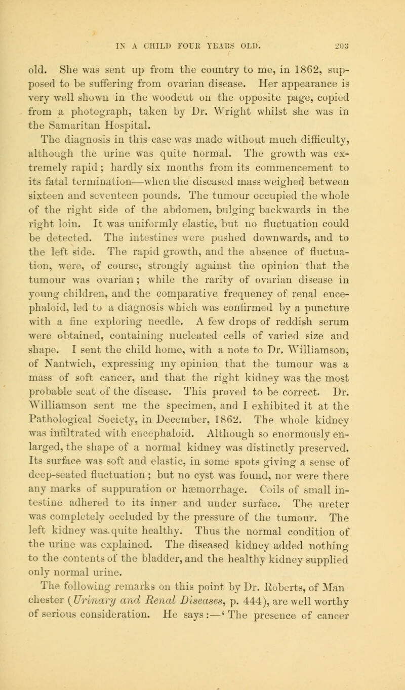 old. She was sent up from the country to me, in 1862, sup- posed to be suffering from ovarian disease. Her appearance is very well shown in the woodcut on the opposite page, copied from a photograph, taken by Dr. Wright whilst she was in the Samaritan Hospital. The diagnosis in this case was made without much difficulty, although the urine was quite normal. The growth was ex- tremely rapid ; hardly six months from its commencement to its fatal termination—when the diseased mass weighed between sixteen and seventeen pounds. The tumour occupied the whole of the right side of the abdomen, bulging backwards in the right loin. It was uniformly elastic, but no fluctuation could be detected. The intestines were pushed downwards, and to the left side. The rapid growth, and the absence of fluctua- tion, were, of course, strongly against the opinion that the tumour was ovarian ; while the rarity of ovarian disease in young children, and the comparative frequency of renal ence- phaloid, led to a diagnosis which was confirmed by a puncture with a fine exploring needle. A few drops of reddish serum were obtained, containing nucleated cells of varied size and shape. I sent the child home, with a note to Dr. Williamson, of Xantwich, expressing my opinion that the tumour was a mass of soft cancer, and that the right kidney was the most probable seat of the disease. This proved to be correct. Dr. Williamson sent me the specimen, and I exhibited it at the Pathological Society, in December, 1862. The whole kidney was infiltrated with encephaloid. Although so enormously en- larged, the shape of a normal kidney was distinctly preserved. Its surface was soft and elastic, in some spots giving a sense of deep-seated fluctuation; but no cyst was found, nor were there any marks of suppuration or haemorrhage. Coils of small in- testine adhered to its inner and under surface. The ureter was completely occluded by the pressure of the tumour. The left kidney was. quite healthy. Thus the normal condition of the urine was explained. The diseased kidney added nothing to the contents of the bladder, and the healthy kidney supplied only normal urine. The following remarks on this point by Dr. Roberts, of Man Chester {Urmary and Renal Diseases, p. 444), are well worthy of serious consideration. He says :—' The presence of cancer