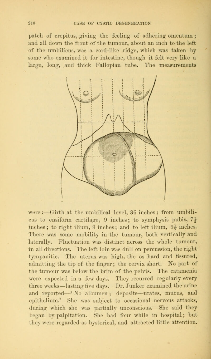 patch of crepitus, giving the feeling of adhering omentum ; and all down the front of tlie tumour, about an inch to the left of the umbilicus, was a cord-like ridge, which was taken by some who examined it for intestine, though it felt very like a large, long, and thick Fallopian tube. The measurements were:—Girth at the umbilical level, 36 inches ; from umbili- cus to ensiform cartilage, 9 inches; to symphysis pubis, 7 J inches ; to right ilium, 9 inches; and to left ilium, 9-J- inches. There was some mobility in the tumour, both vertically and laterally. Fluctuation wTas distinct across the whole tumour, in all directions. The left loin was dull on percussion, the right tympanitic. The uterus was high, the os hard and fissured, admitting the tip of the finger ; the cervix short. Xo part of the tumour was belowr the brim of the pelvis. The catamenia were expected in a fewT days. They recurred regularly every three weeks—lasting five days. Dr. Junker examined the urine and reported—' Xo albumen ; deposits—urates, mucus, and epithelium.' She was subject to occasional nervous attacks, during which she was partially unconscious. She said they began by palpitation. She had four while in hospital; but they were regarded as hysterical, and attracted little attention.