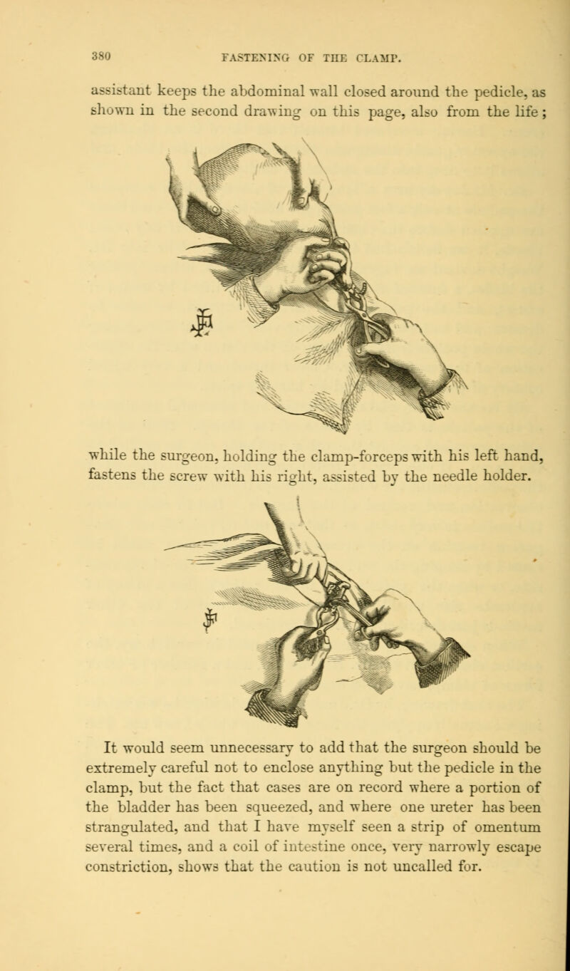 FASTENING OF THE CLAMP. u^i-tant keeps the abdominal wall closed around the pedicle, as shown in the second drawing on this page, also from the life; while the surgeon, holding the clamp-forceps with his left hand, fastens the screw with his right, assisted bv the needle holder. It would seem unnecessary to add that the surgeon should be extremely careful not to enclose anything but the pedicle in the clamp, but the fact that cases are on record where a portion of the bladder has been squeezed, and where one ureter has been strangulated, and that I have myself seen a strip of omentum several times, and a coil of intestine once, very narrowly escape constriction, shows that the caution is not uncalled for.