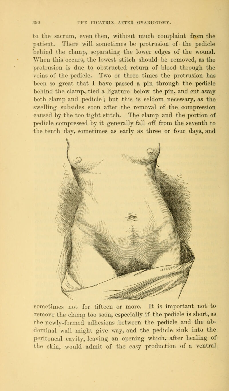 to the sacrum, even then, without much complaint from the patient. There will sometimes be protrusion of the pedicle behind the clamp, separating the lower edges of the wound. When this occurs, the lowest stitch should be removed, as the protrusion is due to obstructed return of blood through the veins of the pedicle. Two or three times the protrusion has been so great that I have passed a pin through the pedicle behind the clamp, tied a ligature below the pin, and cut away both clamp and pedicle ; but this is seldom necessary, as the swelling subsides soon after the removal of the compression caused by the too tight stitch. The clamp and the portion of pedicle compressed by it generally fall off from the seventh to the tenth day, sometimes as early as three or four days, and sometimes not for fifteen or more. It is important not to remove the clamp too soon, especially if the pedicle is short, as the newly-formed adhesions between the pedicle and the ab- dominal wall might give way, and the pedicle sink into the peritoneal cavity, leaving an opening which, after healing of the skin, would admit of the easy production of a ventral