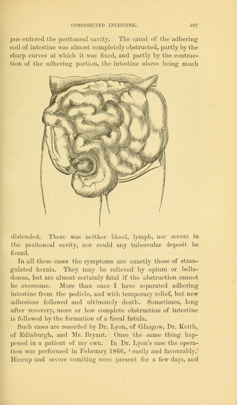 pus entered the peritoneal cavity. The canal of the adhering coil of intestine was almost completely obstructed, partly by the sharp curves at which it was fixed, and partly by the contrac- tion of the adhering portion, the intestine above being much distended. There was neither blood, lymph, nor serum in the peritoneal cavity, nor could any tubercular deposit be found. In all these cases the symptoms are exactly those of stran- gulated hernia. They may be relieved by opium or bella- donna, but are almost certainly fatal if the obstruction cannot be overcome. More than once I have separated adhering intestine from the pedicle, and with temporary relief, but new adhesions followed and ultimately death. Sometimes, long after recovery, more or less complete obstruction of intestine is followed by the formation of a faecal fistula. Such cases are recorded by Dr. Lyon, of Glasgow, Dr. Keith, of Edinburgh, and Mr. Bryant. Once the same thing hap- pened in a patient of my own. In Dr. Lyon's case the opera- tion was performed in February 1866, 'easily and favourably.' Hiccup and severe vomiting were present for a few days, and