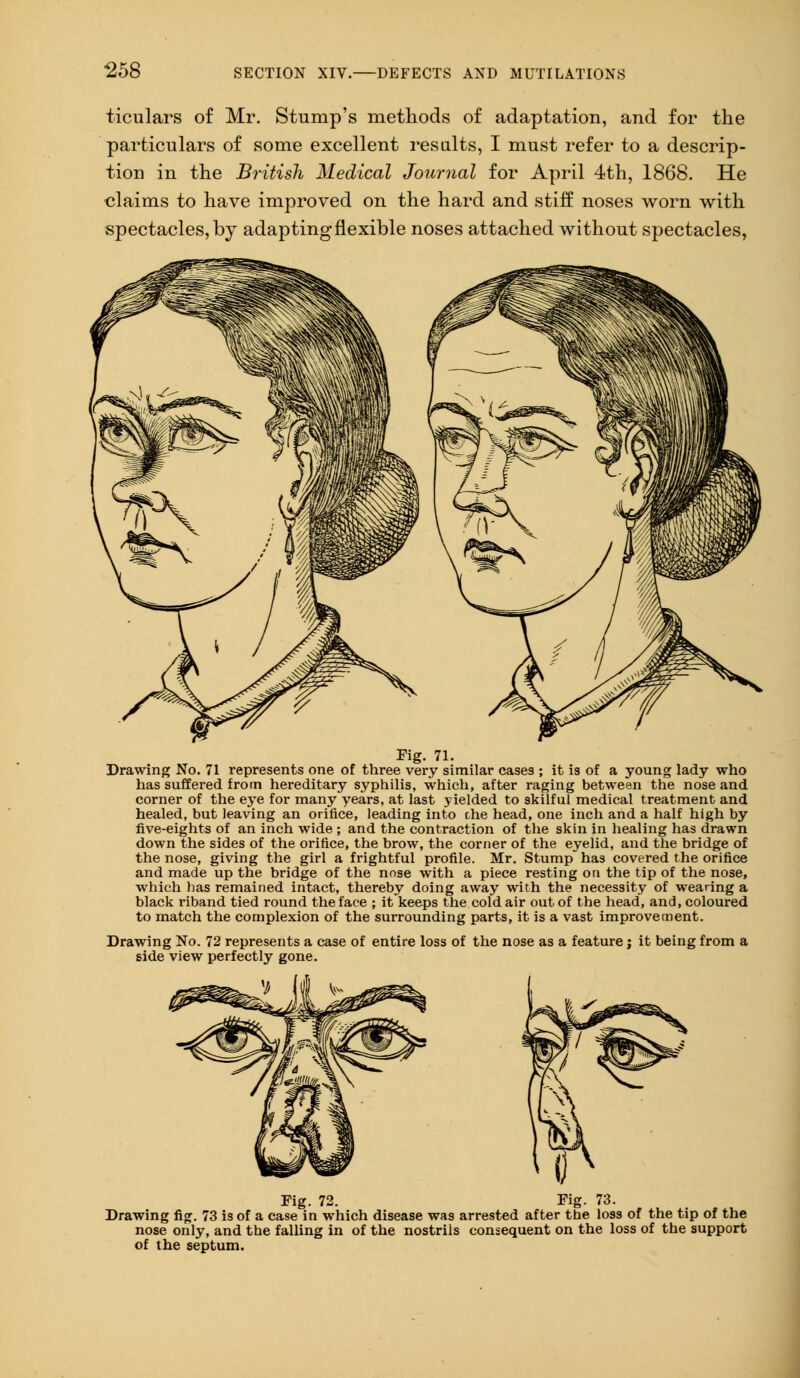ticulars of Mr. Stump's methods of adaptation, and for the particulars of some excellent res alts, I must refer to a descrip- tion in the British Medical Journal for April 4th, 1868. He claims to have improved on the hard and stiff noses worn with spectacles, by adapting flexible noses attached without spectacles, Fig. 71. Drawing No. 71 represents one of three very similar cases ; it is of a young lady who has suffered from hereditary syphilis, which, after raging between the nose and corner of the eye for many years, at last yielded to skilful medical treatment and healed, but leaving an orifice, leading into the head, one inch and a half high by five-eights of an inch wide ; and the contraction of the skin in healing has drawn down the sides of the orifice, the brow, the corner of the eyelid, and the bridge of the nose, giving the girl a frightful profile. Mr. Stump has covered the orifice and made up the bridge of the nose with a piece resting on the tip of the nose, which lias remained intact, thereby doing away with the necessity of wearing a black riband tied round the face ; it keeps the cold air out of the head, and, coloured to match the complexion of the surrounding parts, it is a vast improvement. Drawing No. 72 represents a case of entire loss of the nose as a feature; it being from a side view perfectly gone. Fig. 72. Fig. 73. Drawing fig. 73 is of a case in which disease was arrested after the loss of the tip of the nose only, and the falling in of the nostrils consequent on the loss of the support of the septum.