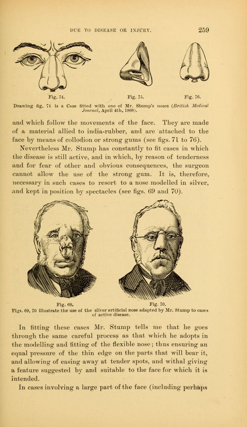 Fig. 74. Fig. 75. Fig. 76. Drawing fig. 71 is a Case fitted with one of Mr. Stump's noses (British Medical Journal, April 4th, 1868). find which follow the movements of the face. They are made of a material allied to india-rubber, and are attached to the face by means of collodion or strong gums (see figs. 71 to 76). Nevertheless Mr. Stump has constantly to fit cases in which the disease is still active, and in which, by reason of tenderness and for fear of other and obvious consequences, the surgeon cannot allow the use of the strong gum. It is, therefore, necessary in such cases to resort to a nose modelled in silver, and kept in position by spectacles (see figs. 69 and 70). Fi-£s. Fig. 69. Fig. 70. ro illustrate the use of the silver artificial nose adapted by Mr. Stump to cases of active disease. In fitting these cases Mr. Stump tells me that he goes through the same careful process as that which he adopts in the modelling and fitting of the flexible nose; thus ensuring an equal pressure of the thin edge on the parts that will bear it, and allowing of easing away at tender spots, and withal giving n feature suggested by and suitable to the face for which it is intended. In cases involving a large part of the face (including perhaps