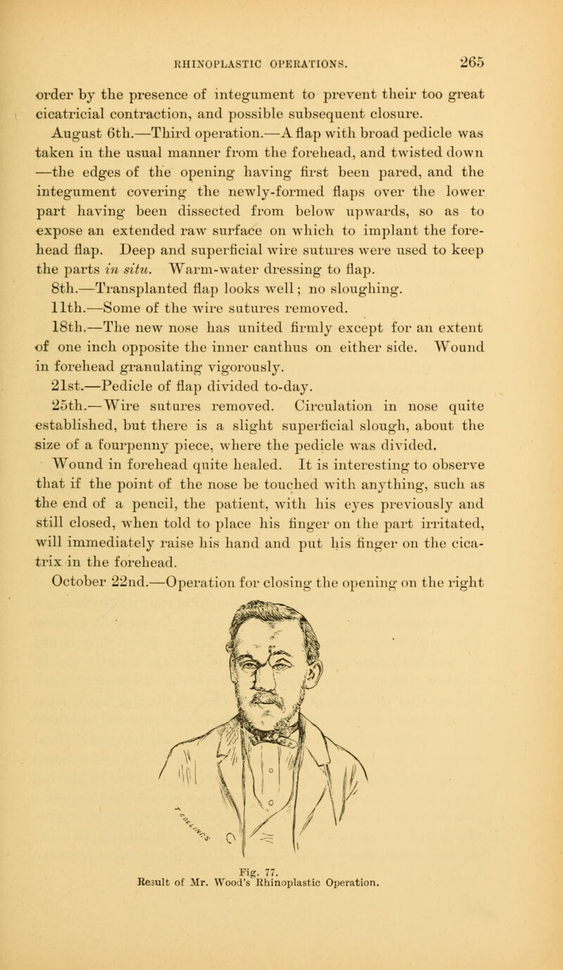 order by the presence of integument to prevent their too great cicatricial contraction, and possible subsequent closure. August 6th.—Third operation.—A flap with broad pedicle was taken in the usual manner from the forehead, and twisted down —the edges of the opening having first been pared, and the integument covering the newly-formed flaps over the lower part having been dissected from below upwards, so as to expose an extended raw surface on which to implant the fore- head flap. Deep and superficial wire sutures were used to keep the parts in situ. Warm-water dressing to flap. 8th.—Transplanted flap looks well; no sloughing. 11th.—Some of the wire sutures removed. 18th.—The new nose has united firmly except for an extent of one inch opposite the inner canthus on either side. Wound in forehead granulating vigorously. 21st.—Pedicle of flap divided to-day. 25th.—Wire sutures removed. Circulation in nose quite established, but there is a slight superficial slough, about the size of a fourpenny piece, where the pedicle was divided. Wound in forehead quite healed. It is interesting to observe that if the point of the nose be touched with anything, such as the end of a pencil, the patient, with his eyes previously and still closed, when told to place his finger on the part irritated, will immediately raise his hand and put his finger on the cica- trix in the forehead. October 22nd.—Operation for closing the opening on the right Fig. 77. Result of Mr. Wood's Homoplastic Operation.