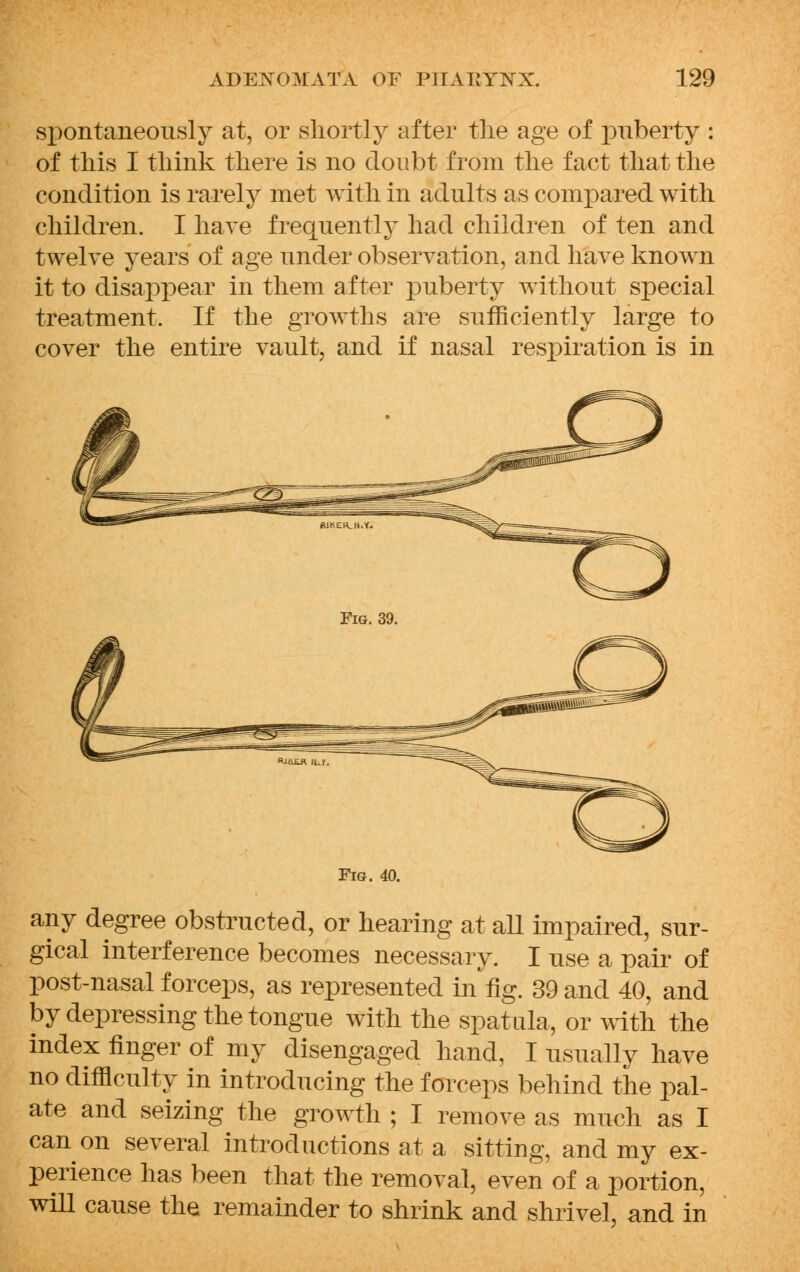 spontaneously at, or shortly after the age of puberty : of this I think there is no doubt from the fact that the condition is rarely met with in adults as compared with children. I have frequently had children of ten and twelve years of age under observation, and have known it to disappear in them after puberty without special treatment. If the growths are sufficiently large to cover the entire vault, and if nasal respiration is in Fig. 40. any degree obstructed, or hearing at all impaired, sur- gical interference becomes necessary. I use a pair of post-nasal forceps, as represented in fig. 39 and 40, and by depressing the tongue with the spatula, or with the index finger of my disengaged hand, I usually have no difficulty in introducing the forceps behind the pal- ate and seizing the growth ; I remove as much as I canon several introductions at a sitting, and my ex- perience has been that the removal, even of a portion, will cause the remainder to shrink and shrivel, and in