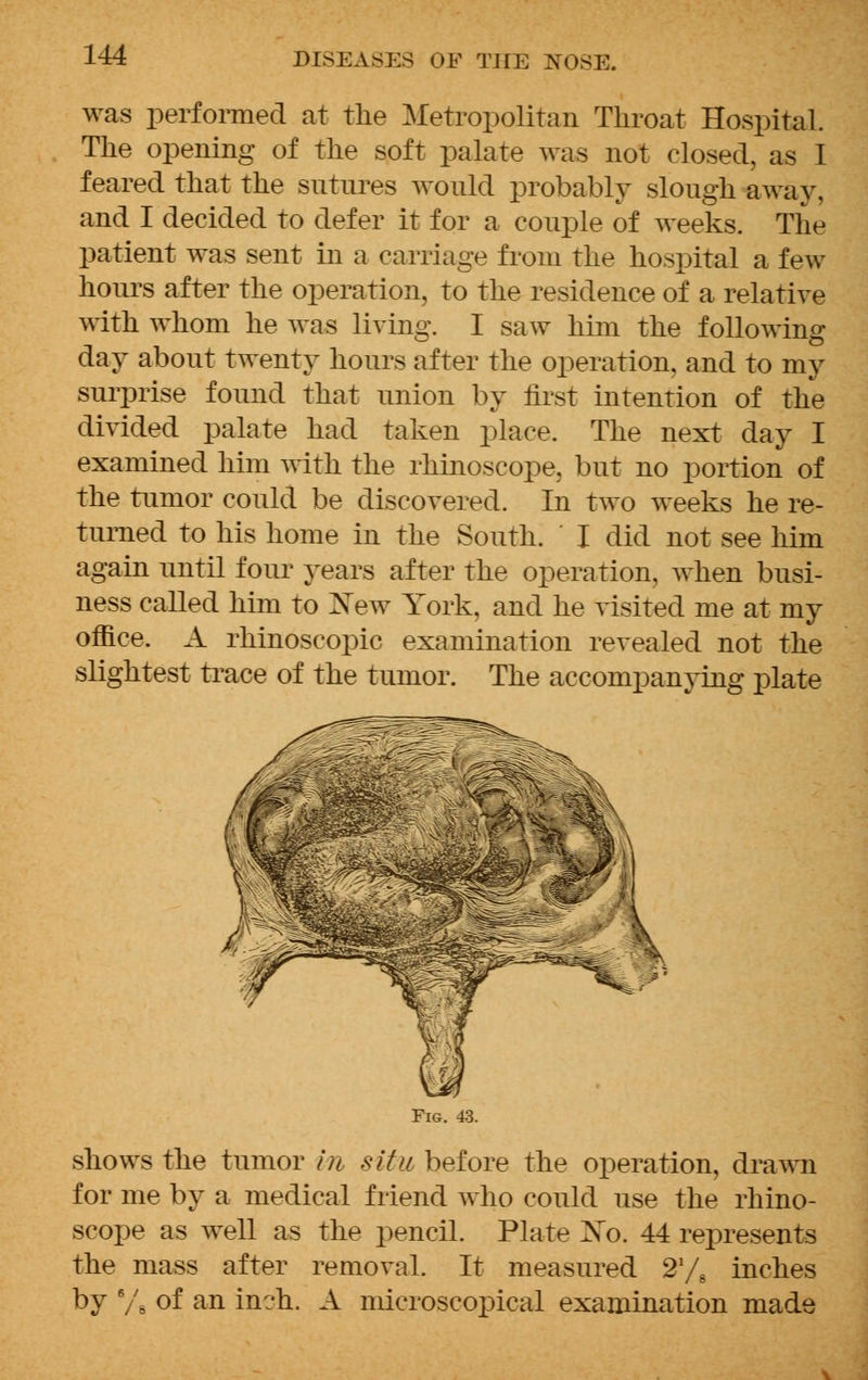 was performed at the Metropolitan Throat Hospital. The opening of the soft palate was not closed, as I feared that the sutures would probably slough away, and I decided to defer it for a couple of weeks. The patient was sent in a carriage from the hospital a few hours after the operation, to the residence of a relative with whom he was living. I saw him the following day about twenty hours after the operation, and to my surprise found that union by first intention of the divided palate had taken place. The next day I examined him with the rhinoscope, but no portion of the tumor could be discovered. In two weeks he re- turned to his home in the South. I did not see him again until four years after the operation, when busi- ness called him to Xew York, and he visited me at my office. A rhinoscopic examination revealed not the slightest trace of the tumor. The accompanying plate Fig. 43. shows the tumor in situ before the operation, drawn for me by a medical friend who could use the rhino- scope as well as the pencil. Plate Xo. 44 represents the mass after removal. It measured 2*/s inches by 6/6 of an inch. A microscopical examination made
