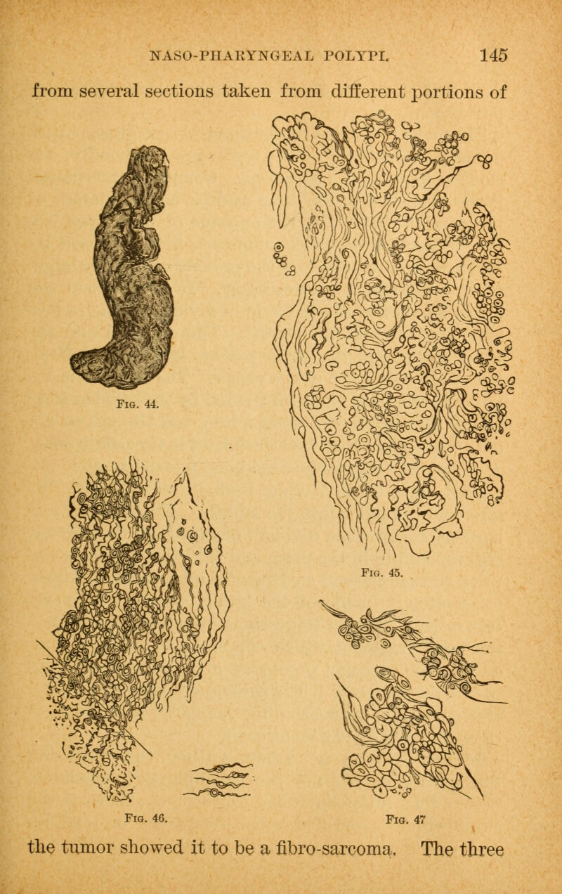 from several sections taken from different portions of Fig. 44. Fig. 45. Fig. 46. Fig. 47 the tumor showed it to be a fibro-sarcoma. The three