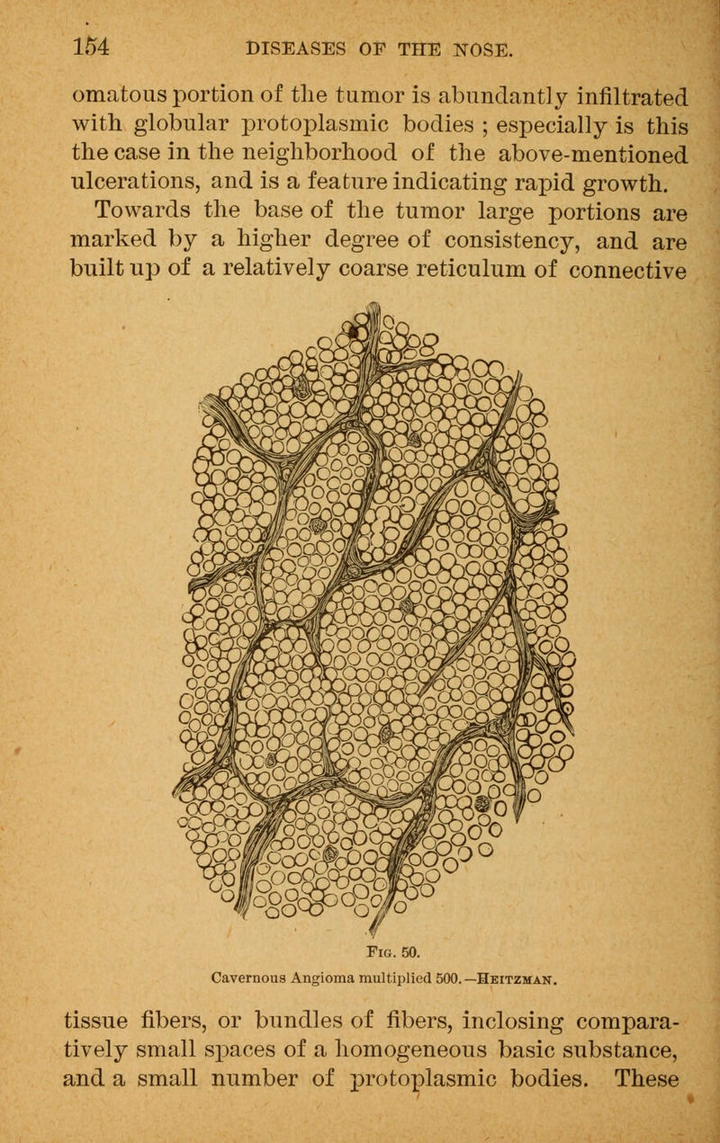 omatous portion of the tumor is abundantly infiltrated with globular protoplasmic bodies ; especially is this the case in the neighborhood of the above-mentioned ulcerations, and is a feature indicating rapid growth. Towards the base of the tumor large portions are marked by a higher degree of consistency, and are built up of a relatively coarse reticulum of connective Fig. 50. Cavernous Angioma multiplied 500.—Heitzman. tissue fibers, or bundles of fibers, inclosing compara- tively small spaces of a homogeneous basic substance, and a small number of protoplasmic bodies. These