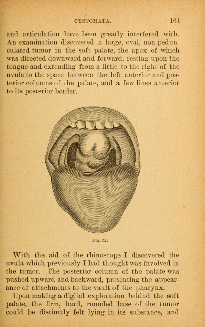 and articulation have been greatly interfered with. An examination discovered a large, oval, non-pedun- culated tumor in the soft palate, the apex of which was directed downward and forward, resting upon the tongue and extending from a little to the right of the uvula to the space between the left anterior and pos- terior columns of the palate, and a few lines anterior to its posterior border. Fig. 52. With the aid of the rhinoscope I discovered the uvula which previously I had thought was involved in the tumor. The posterior column of the palate was pushed upward and backward, presenting the appear- ance of attachments to the vault of the pharynx. Upon making a digital exploration behind the soft palate, the firm, hard, rounded base of the tumor could be distinctly felt lying in its substance, and