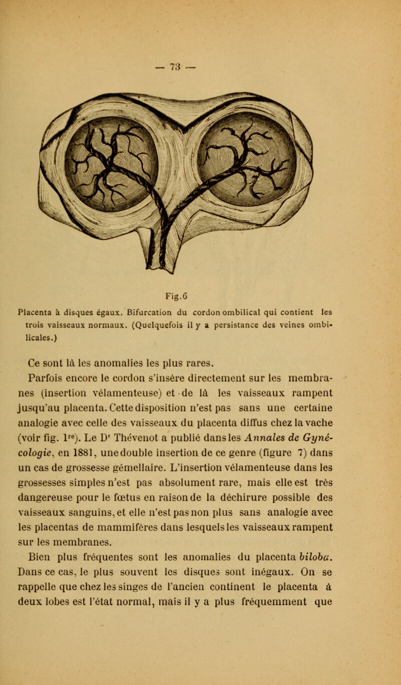 Placenta à disques égaux. Bifurcation du cordon ombilical qui contient les trois vaisseaux normaux. (Quelquefois il y a persistance des veines ombi- licales.) Ce sont kl les anomalies les plus rares. Parfois encore le cordon s'insère directement sur les membra- nes (insertion vélamenteuse) et de là les vaisseaux rampent jusqu'au placenta. Cette disposition n'est pas sans une certaine analogie avec celle des vaisseaux du placenta diffus chez la vache (voir fig. lre). Le Dr Thévenot a publié dans les Annales de Gyné- cologie, en 1881. une double insertion de ce genre (figure 7) dans un cas de grossesse gémellaire. L'insertion vélamenteuse dans les grossesses simples n'est pas absolument rare, mais elle est très dangereuse pour le fœtus en raison de la déchirure possible des vaisseaux sanguins, et elle n'est pas non plus sans analogie avec les placentas de mammifères dans lesquels les vaisseaux rampent sur les membranes. Bien plus fréquentes sont les anomalies du placenta biloba. Dans ce cas, le plus souvent les disques sont inégaux. On se rappelle que chez les singes de l'ancien continent le placenta à deux lobes est l'état normal, mais il y a plus fréquemment que