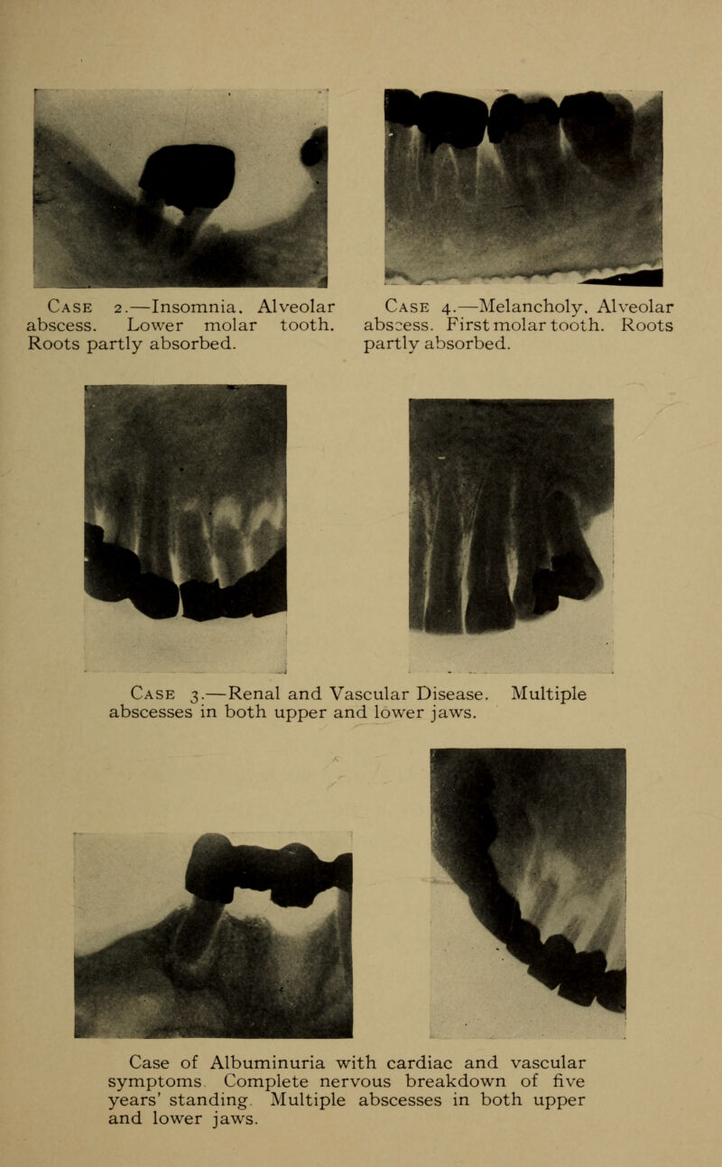 Case 2.—Insomnia. Alveolar abscess. Lower molar tooth. Roots partly absorbed. Case 4.—Melancholy, Alveolar abscess. First molar tooth. Roots partly absorbed. Case 3.—Renal and Vascular Disease. Multiple abscesses in both upper and lower jaws. Case of Albuminuria with cardiac and vascular symptoms. Complete nervous breakdown of five years' standing Multiple abscesses in both upper and lower jaws.