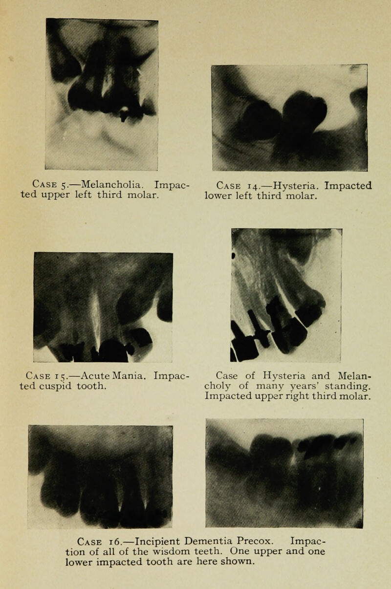 Case 5.—Melancholia. Impac- ted upper left third molar. Case 14.—Hysteria. Impacted lower left third molar. Case 15.—Acute Mania. Impac- ted cuspid tooth. Case of Hysteria and Melan- choly of many years' standing. Impacted upper right third molar. Case 16.—Incipient Dementia Precox. Impac- tion of all of the wisdom teeth. One upper and one lower impacted tooth are here shown.