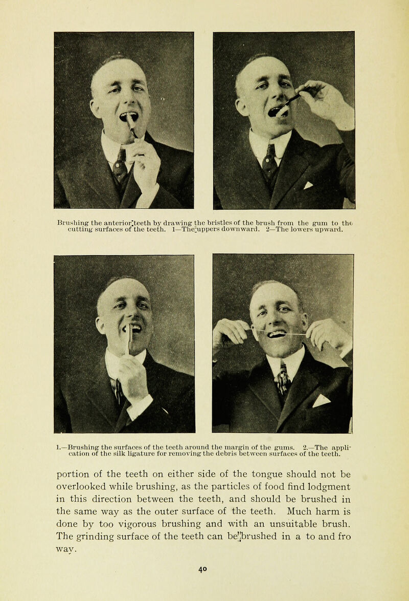 Brushing the anteriorltceth by dra\^ing the bi-istlcs of the brush from the grim to thfc cutting surfaces of the teeth. 1—The^ppcrs downward. 2—The lowers upward. 1.—Brushing the surfaces of the teeth around the margin of the gunis. 2.—The appli- cation of the silk ligature for removing the debris between surfaces of the teeth. portion of the teeth on either side of the tongue should not be overlooked while brushing, as the particles of food find lodgment in this direction between the teeth, and should be brushed in the same way as the outer surface of the teeth. Much harm is done by too vigorous brushing and with an unsuitable brush. The grinding surface of the teeth can be'jbrushed in a to and fro wav.