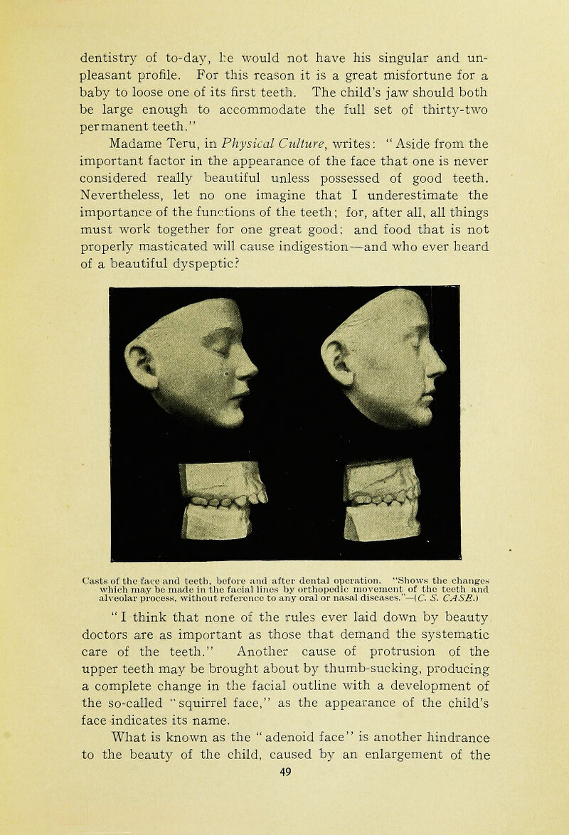 dentistry of to-day, l:e would not have his singular and un- pleasant profile. For this reason it is a great misfortune for a baby to loose one of its first teeth. The child's jaw should both be large enough to accommodate the full set of thirty-two permanent teeth. Madame Teru, in Physical Culture, writes:  Aside from the important factor in the appearance of the face that one is never considered really beautiful unless possessed of good teeth. Nevertheless, let no one imagine that I underestimate the importance of the functions of the teeth; for, after all, all things must work together for one great good: and food that is not properly masticated will cause indigestion—and who ever heard of a beautiful dyspeptic? Casts of the face and teeth, before and after dental operation. Shows the changrcs which may be made in the facial lines by orthopedic movement^ of the teeth and alveolar proces.^, without reference to any oral or nasal diseases.—(C J>. CASE.)  I think that none of the rules ever laid down by beauty doctors are as important as those that demand the systematic care of the teeth. Another cause of protrusion of the upper teeth may be brought about by thumb-sucking, producing a complete change in the facial outline with a development of the so-called squirrel face, as the appearance of the child's face indicates its name. What is known as the adenoid face is another hindrance to the beauty of the child, caused by an enlargement of the